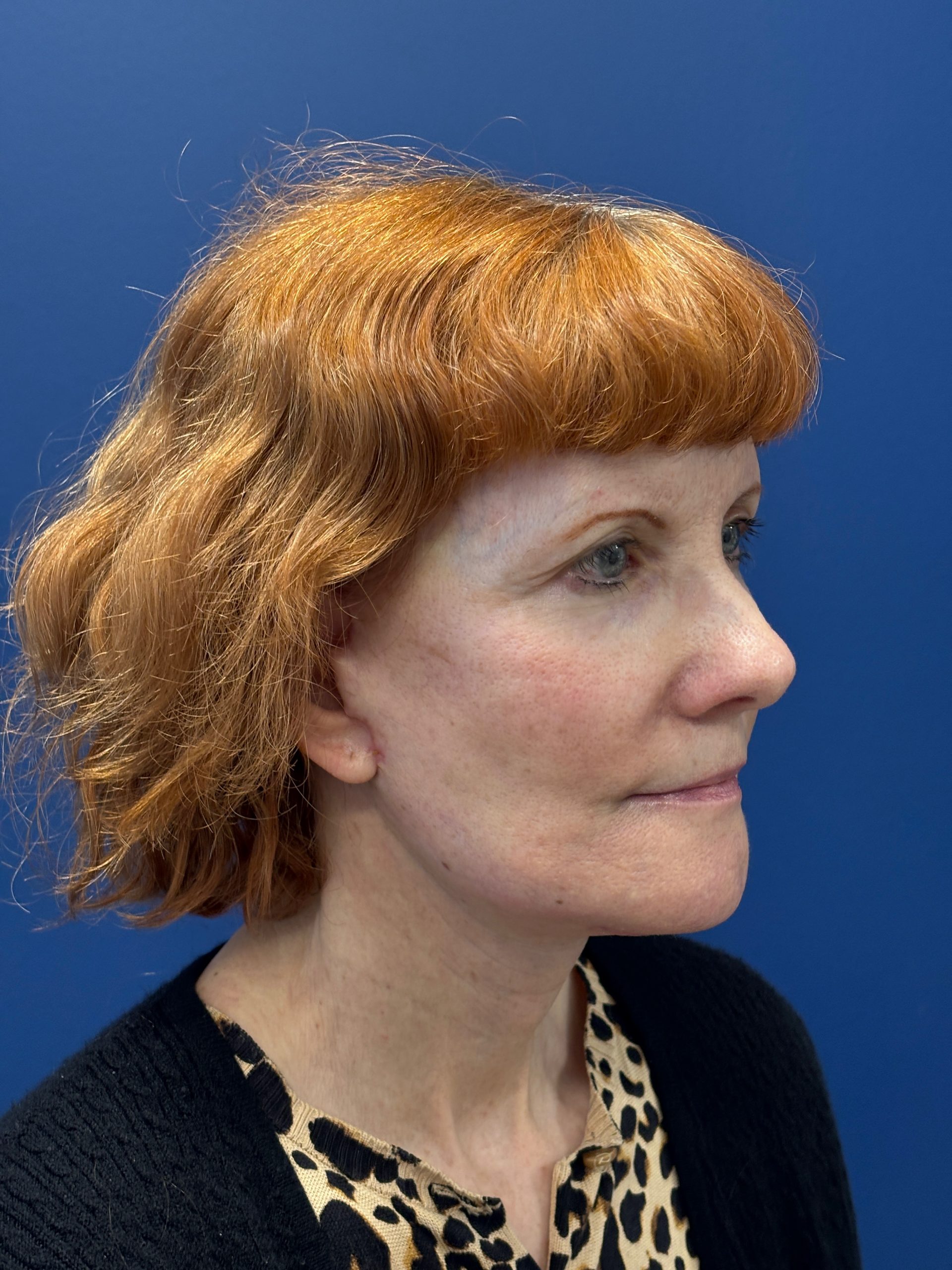 Facelift-Facial-Fat-Grafting-Neck-Lift-Case--6778 | After Face360 5