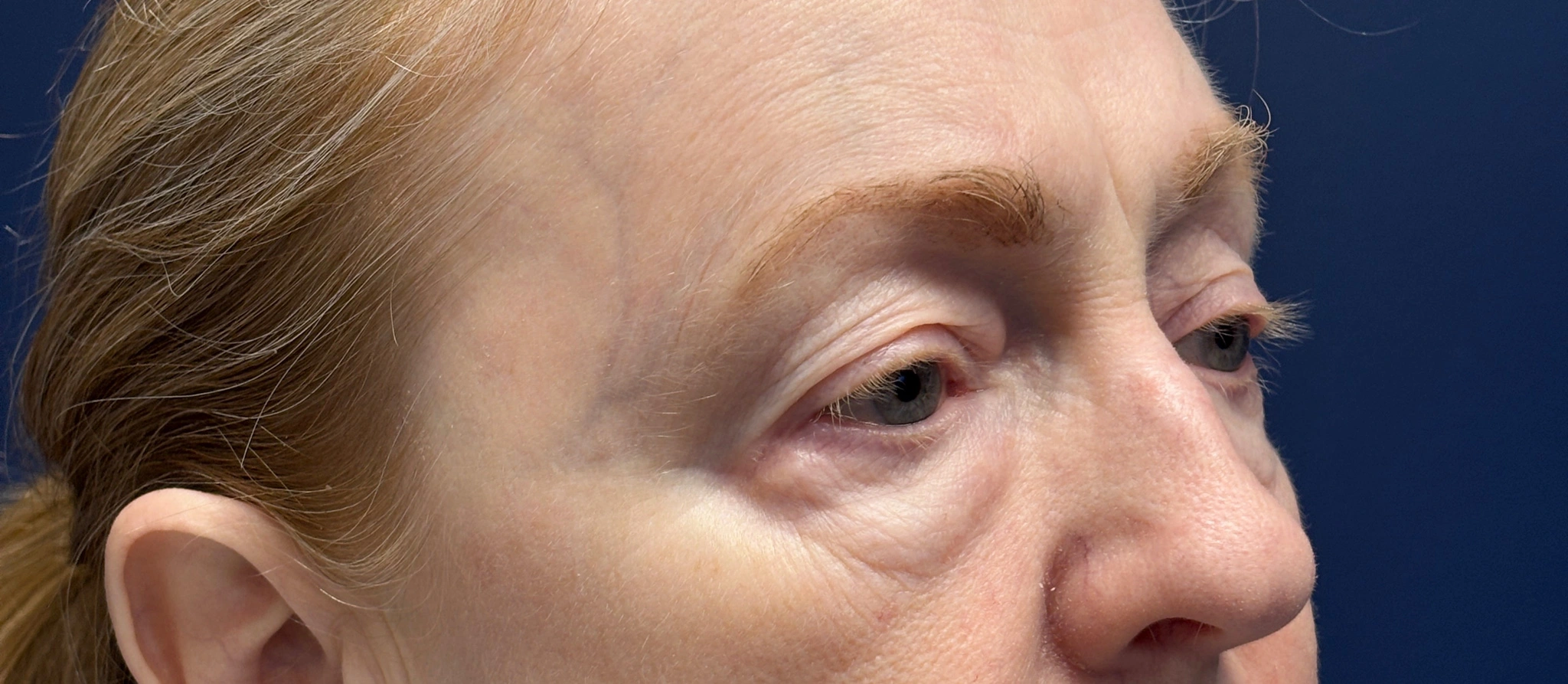 Blepharoplasty-Case--2019 | Before Eyelid Surgery 4
