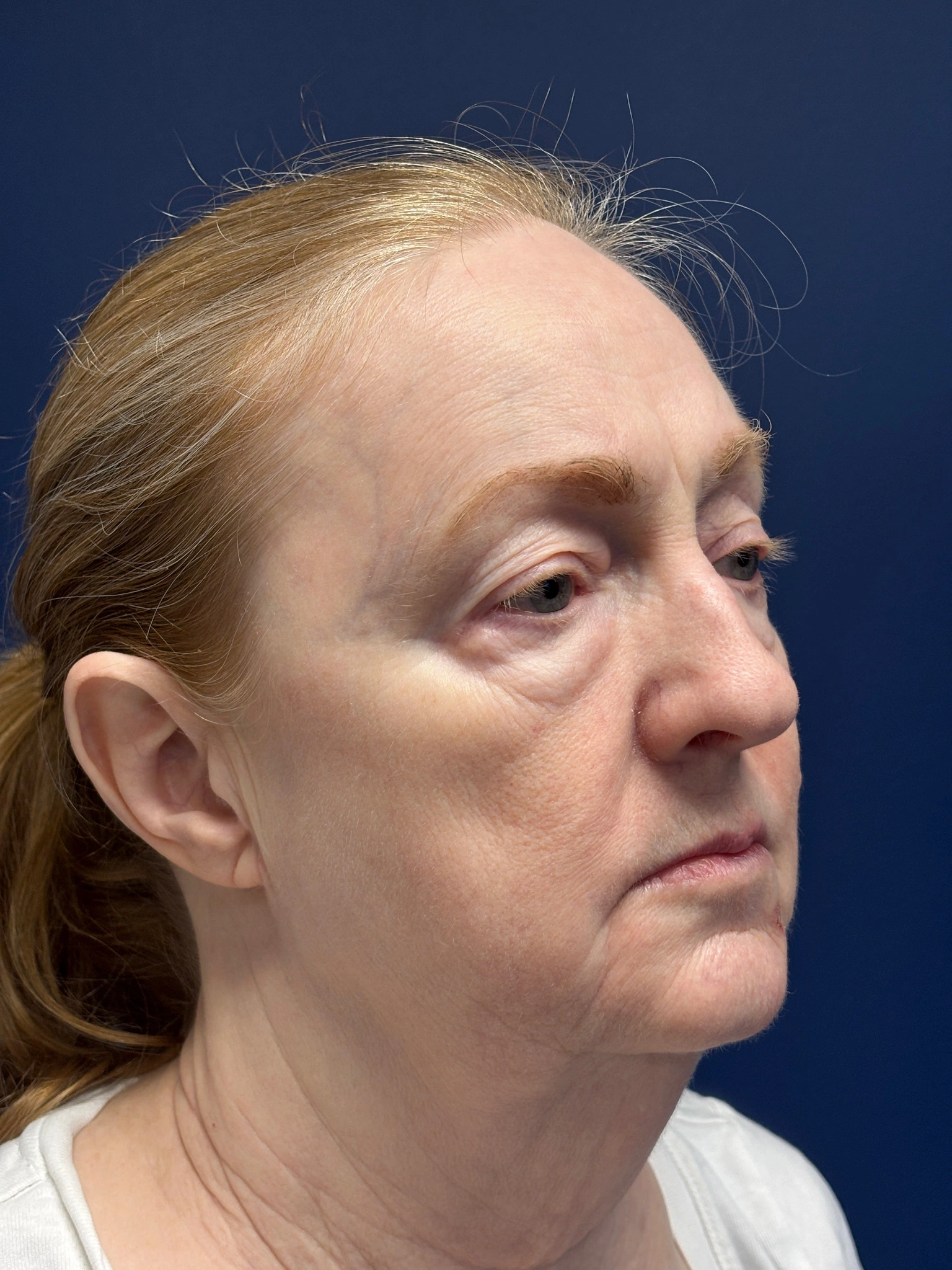 Facelift-and-Facial-Fat-Grafting-Case--3549 | Before Facelift 4