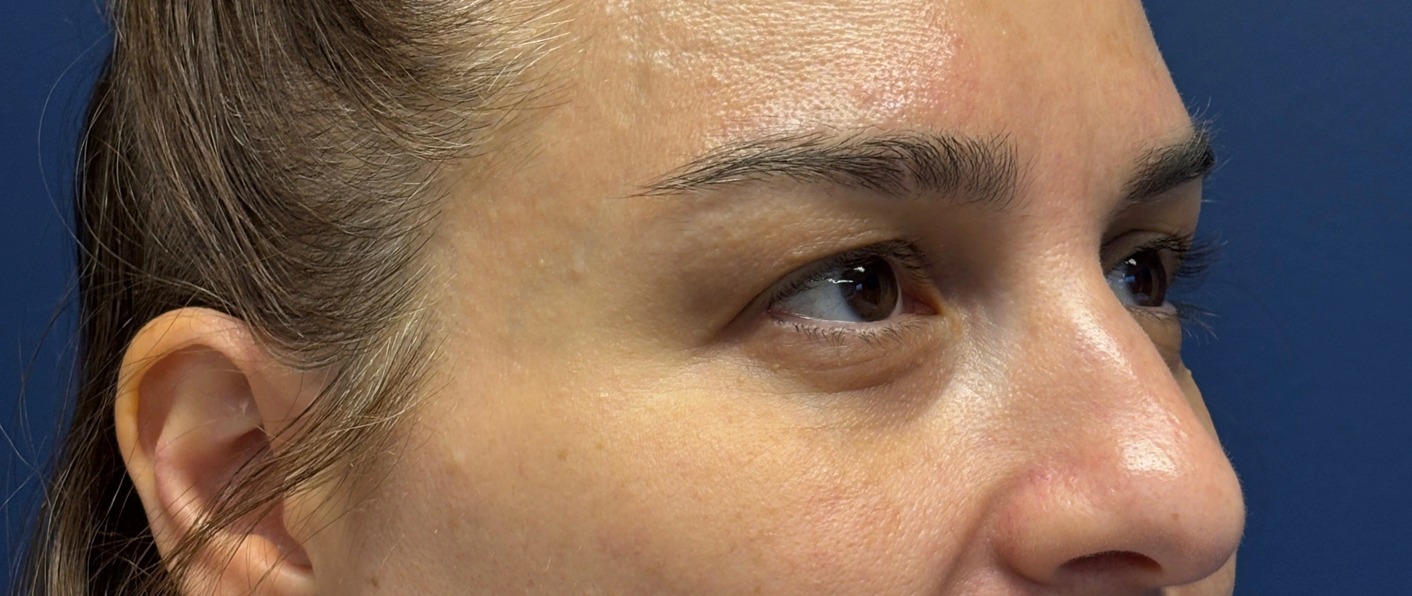 Blepharoplasty-Case--5118 | Before Eyelid Surgery 3