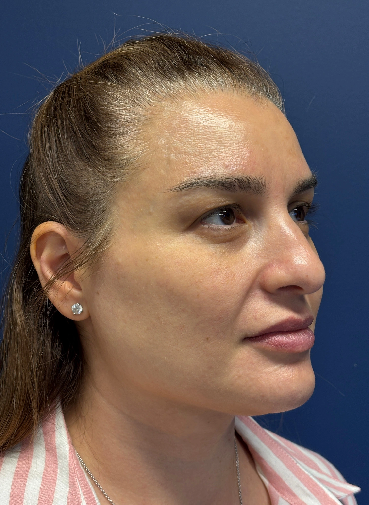 Facelift-and-Facial-Fat-Grafting-Case--7977 | Before Facelift 3