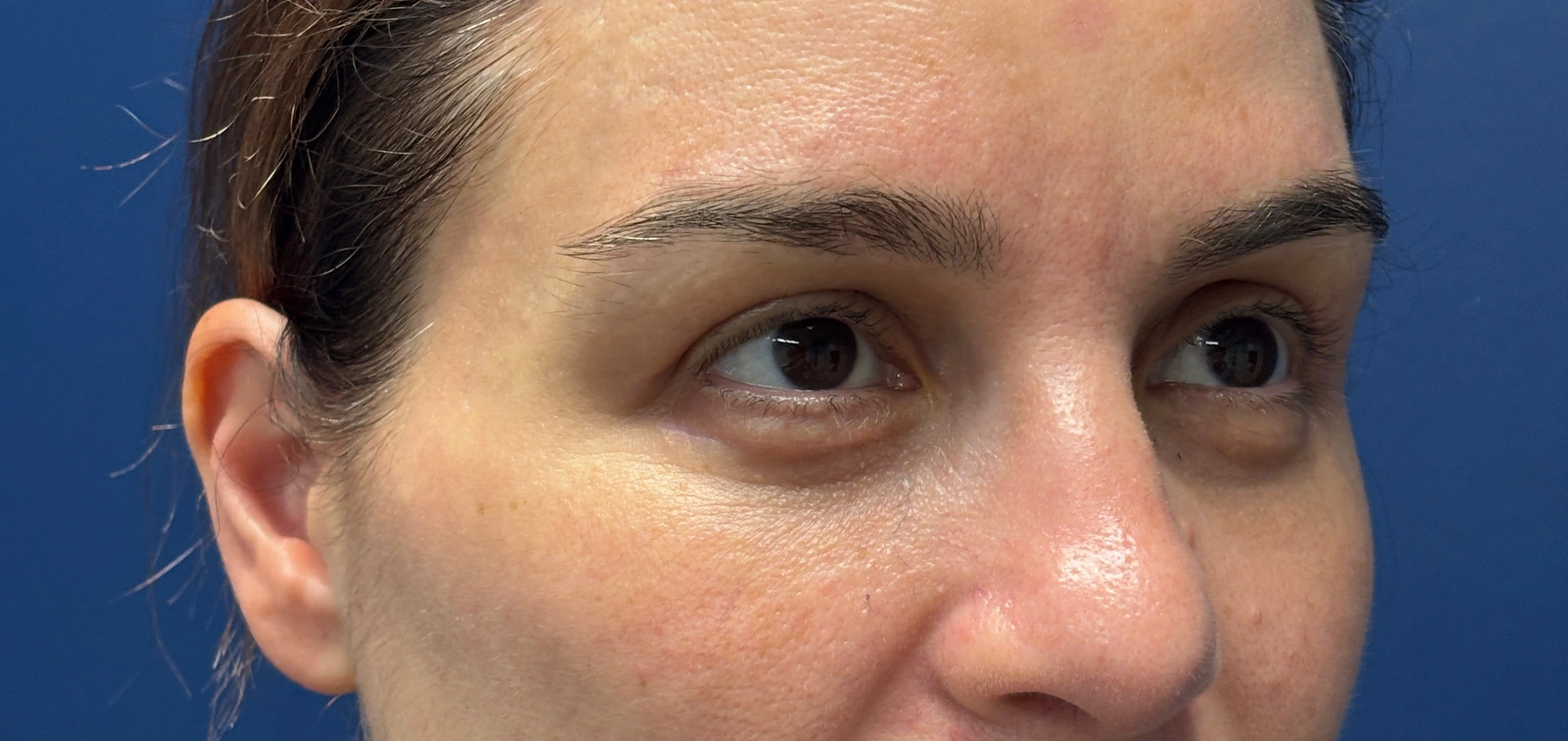 Blepharoplasty-Case--5118 | After Eyelid Surgery 3