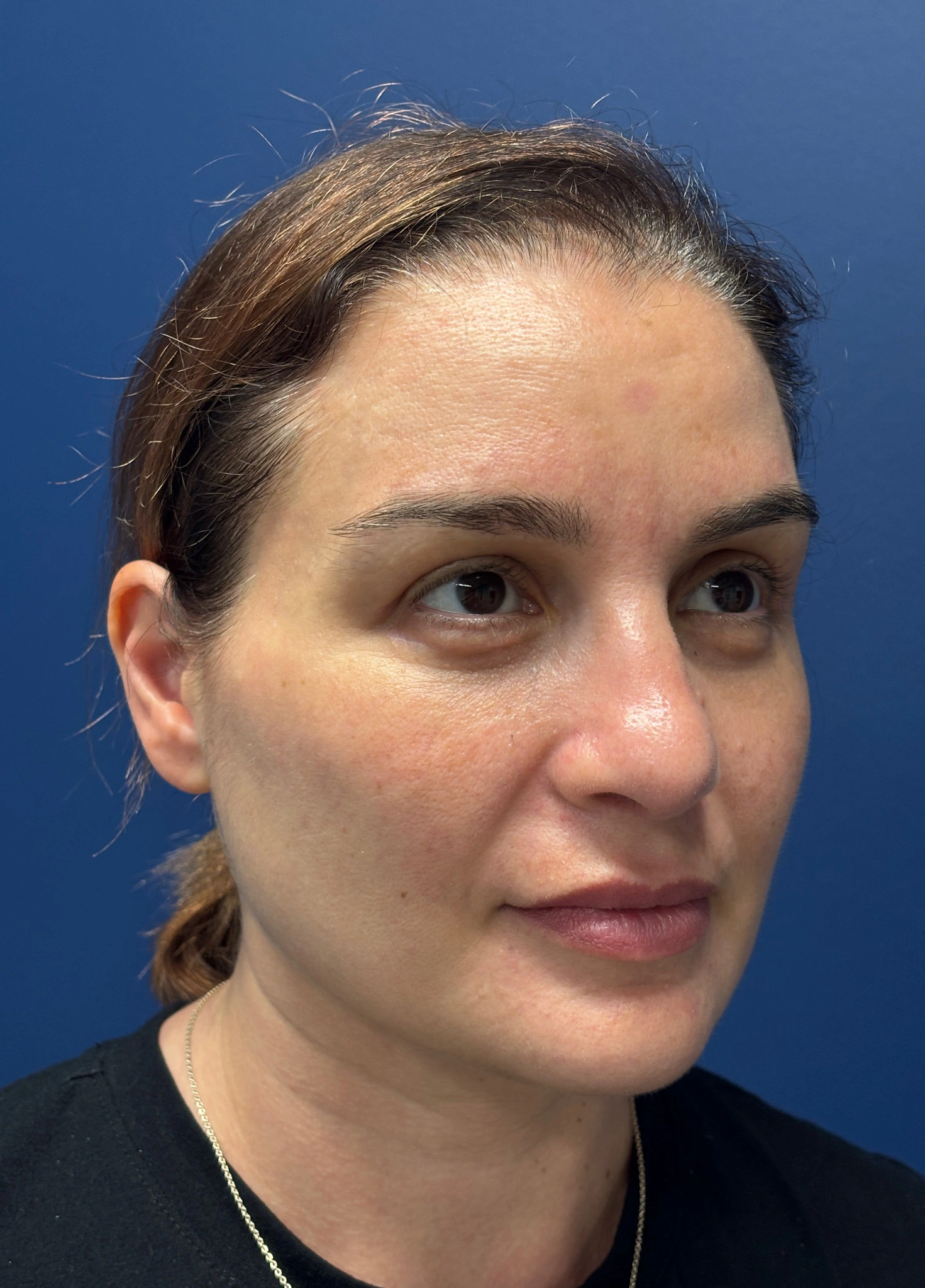 Facelift-and-Facial-Fat-Grafting-Case--7977 | After Facelift 3