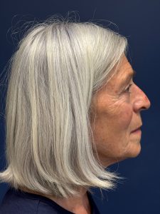 Facelift-Facial-Fat-Grafting-Browlift-Blepharoplasty-Necklift-Case--4176 | Before Face360 2