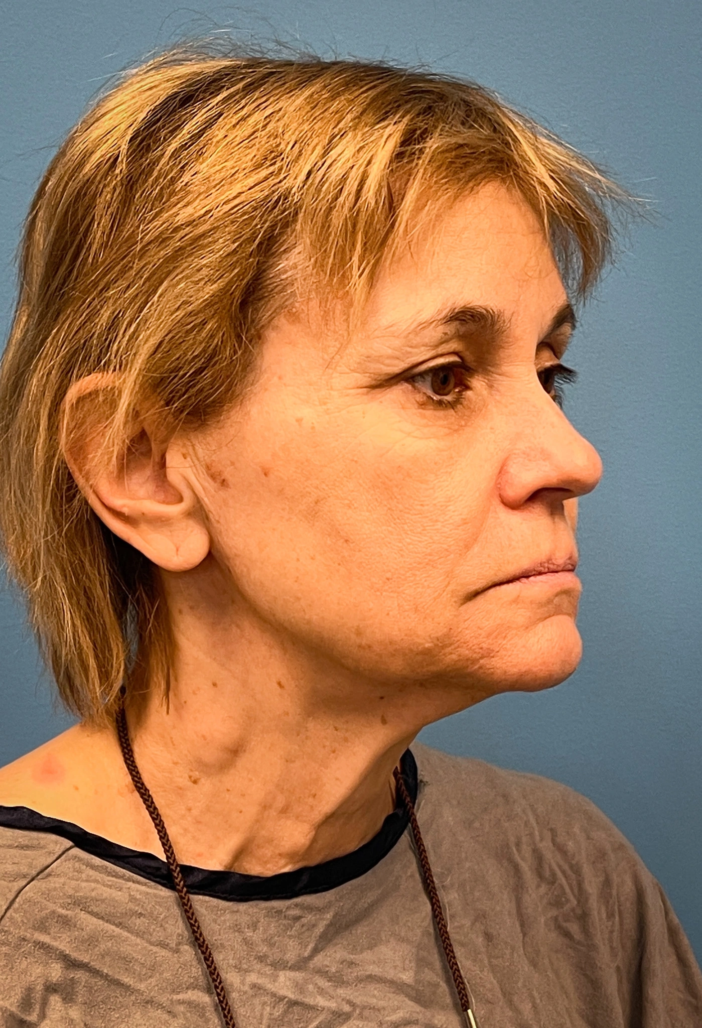 Facelift-Case--8739 | Before Facelift 3