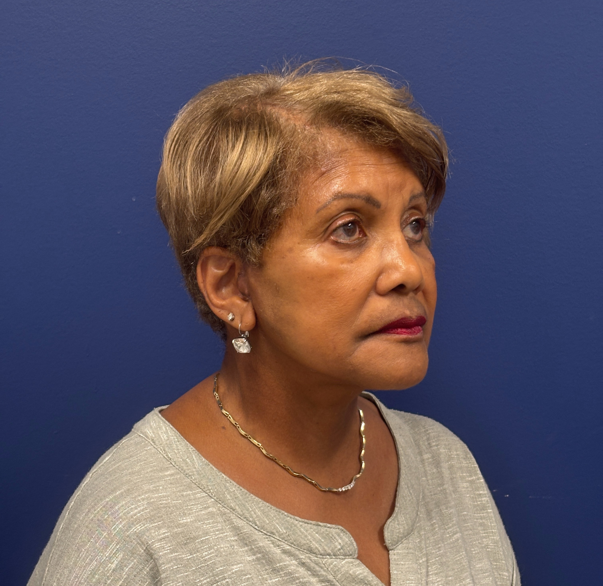 Facelift-Facial-Fat-Graft-Neck-Lift-Case--4262 | After Face360 4