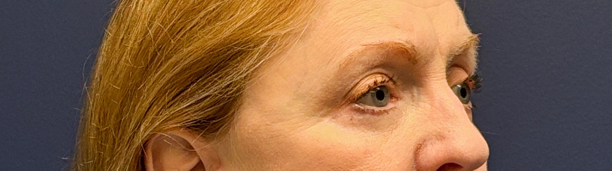 Blepharoplasty-Case--2019 | After Eyelid Surgery 4