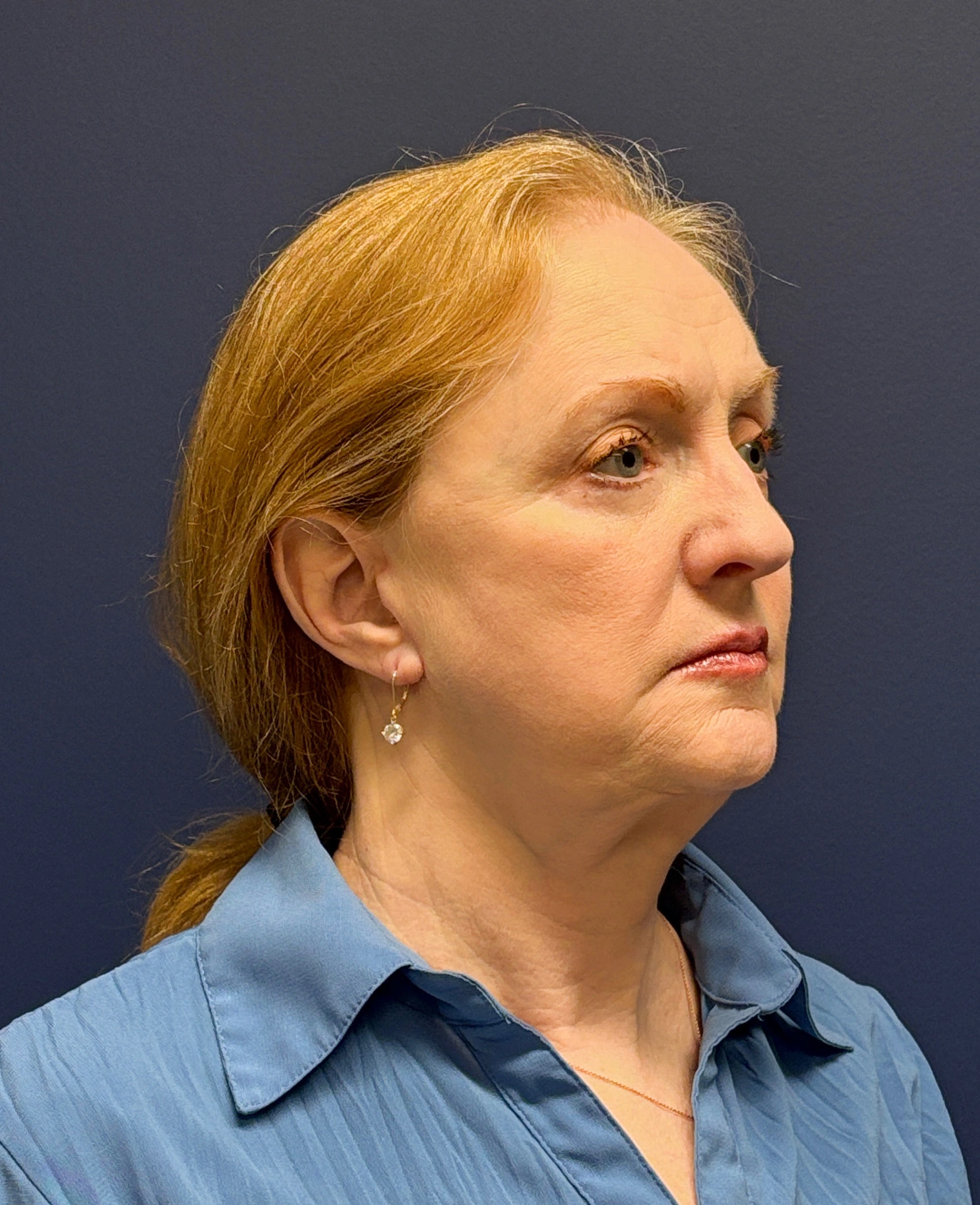 Facelift-and-Facial-Fat-Grafting-Case--3549 | After Facelift 4