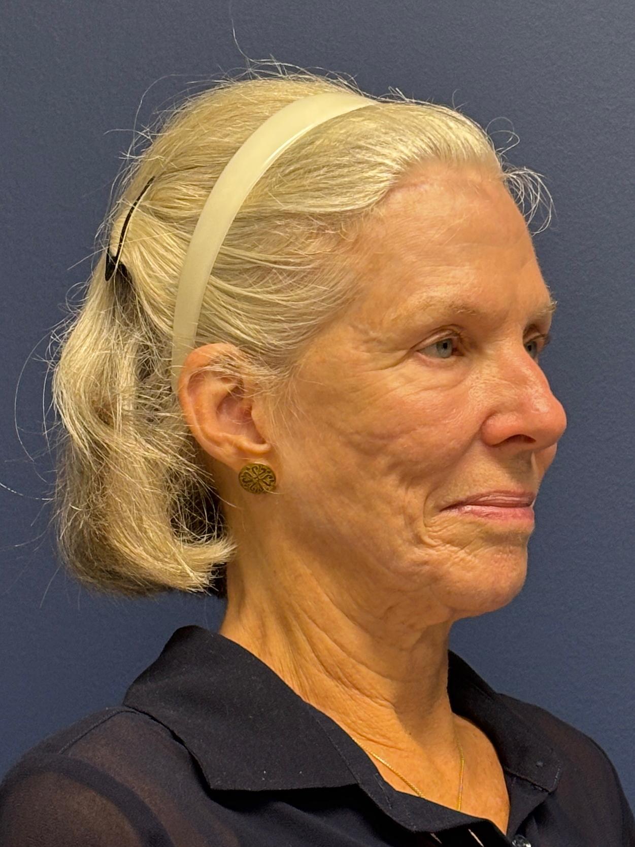 Facelift-Facial-Fat-Grafting-Neck-Lift-Case--1414 | Before Face360 5