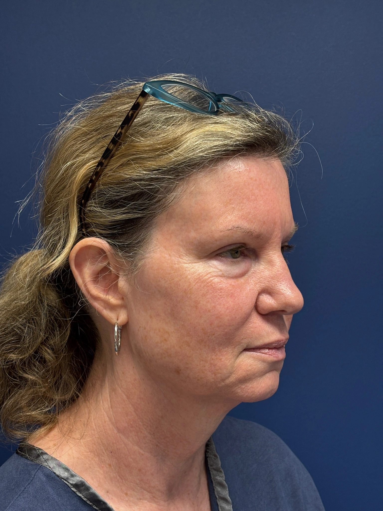 Facelift-Case--2304 | Before Facelift 3