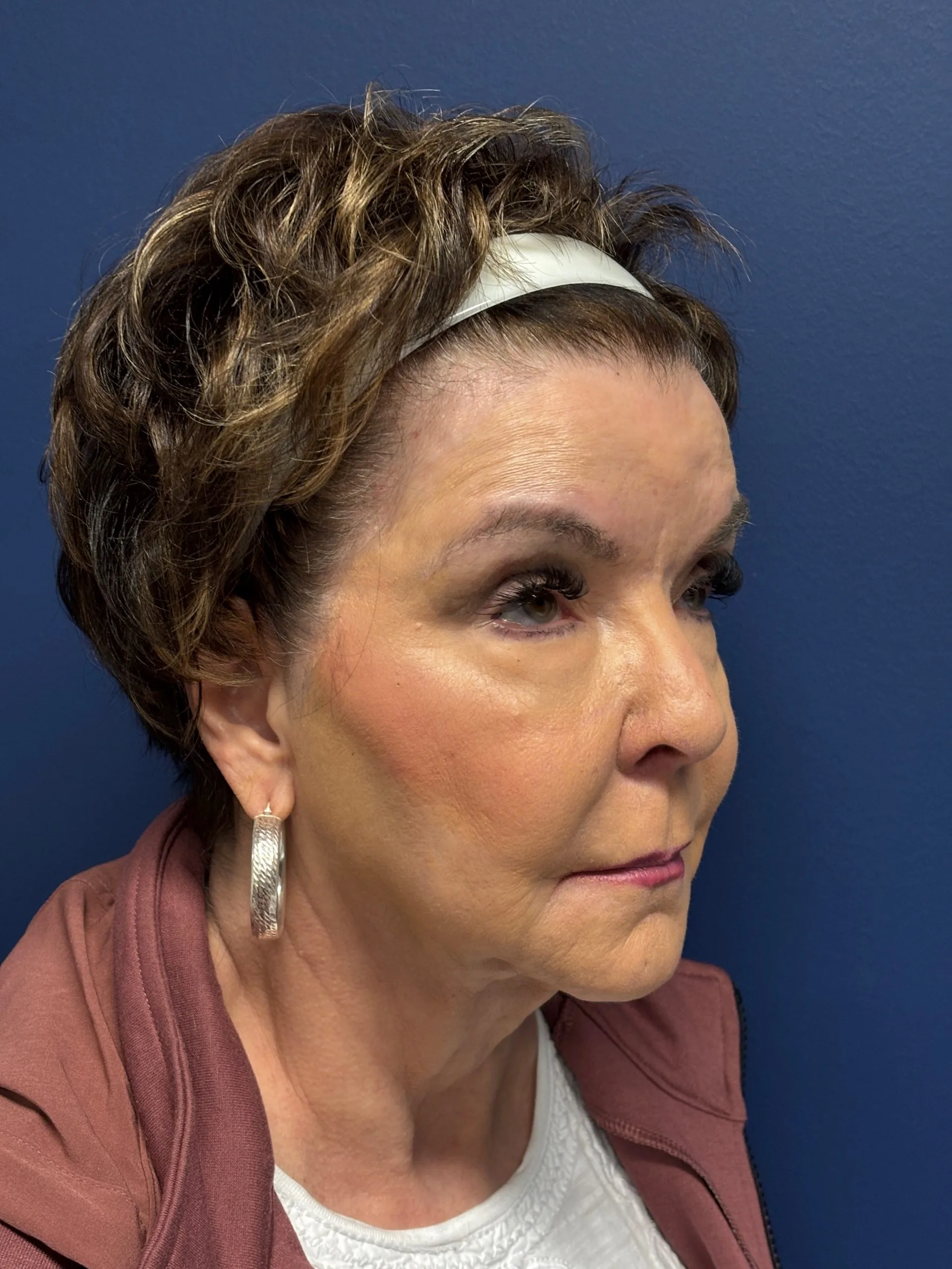 Facelift-Case--6613 | Before Facelift 3