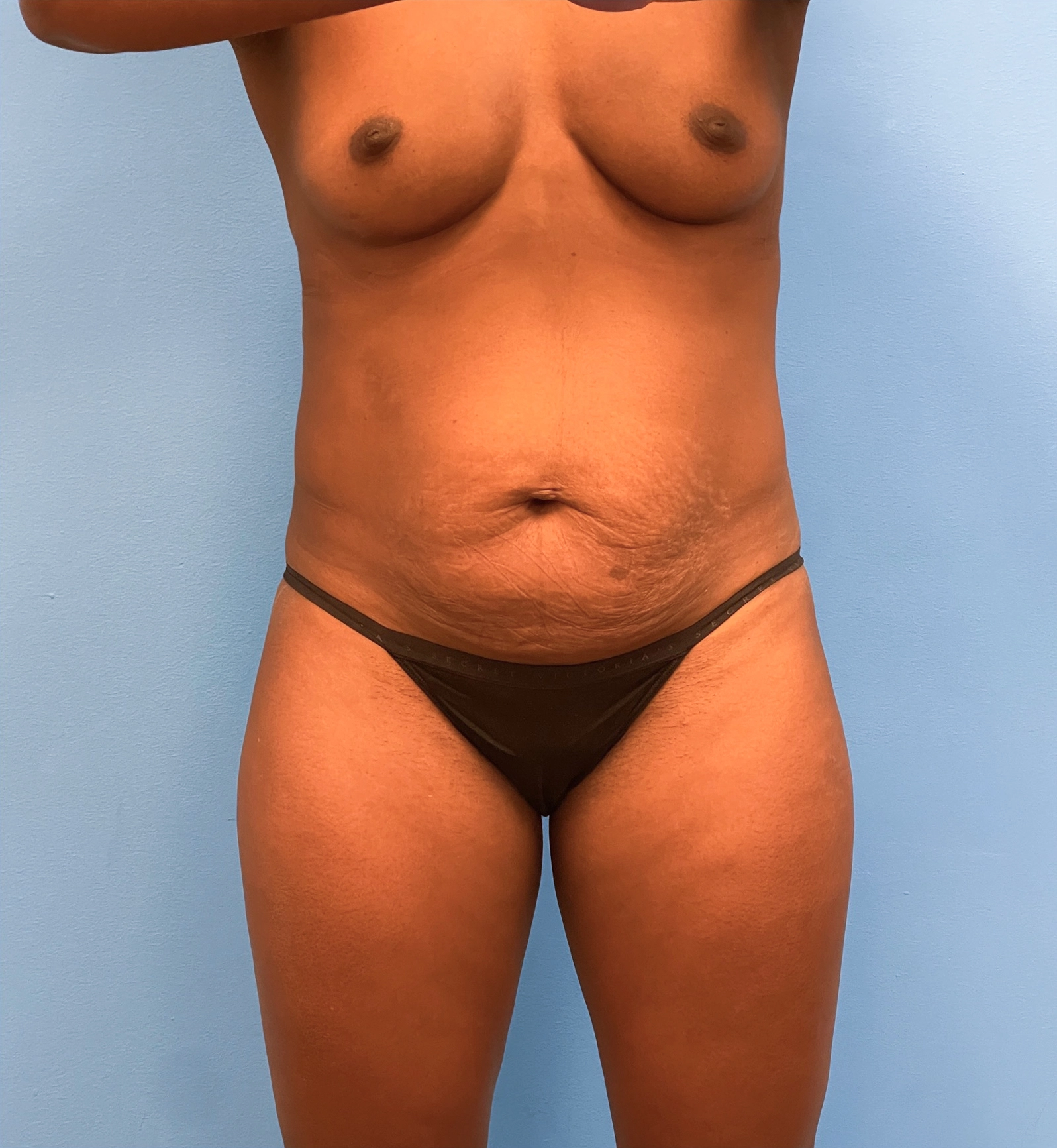 Abdominoplasty-Case--28134 | Before Tummy Tuck 1
