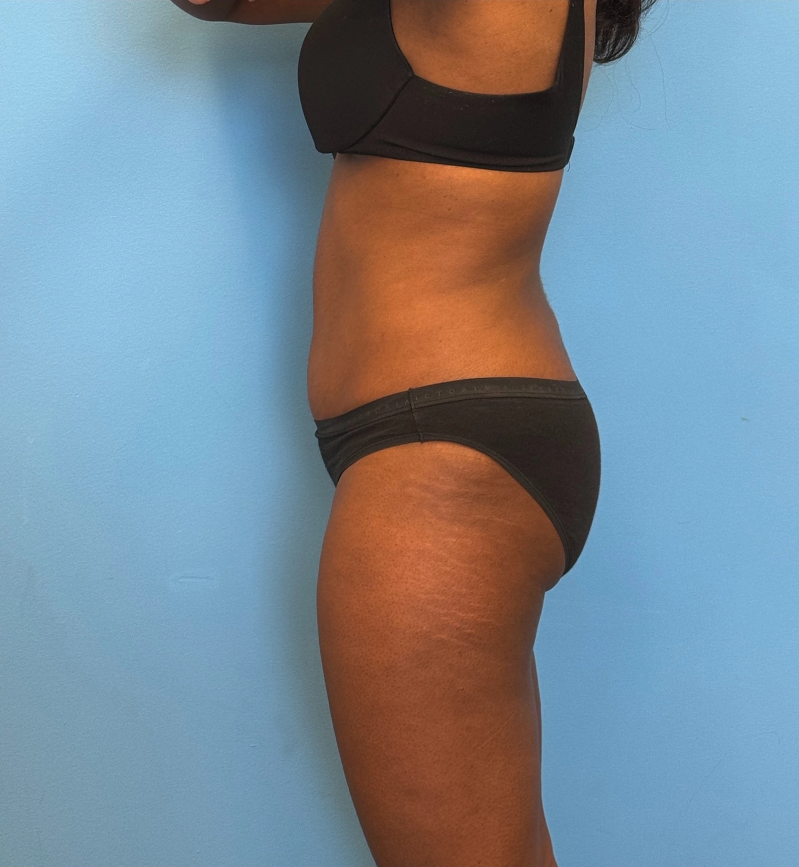 Abdominoplasty-Case--28134 | After Tummy Tuck 3