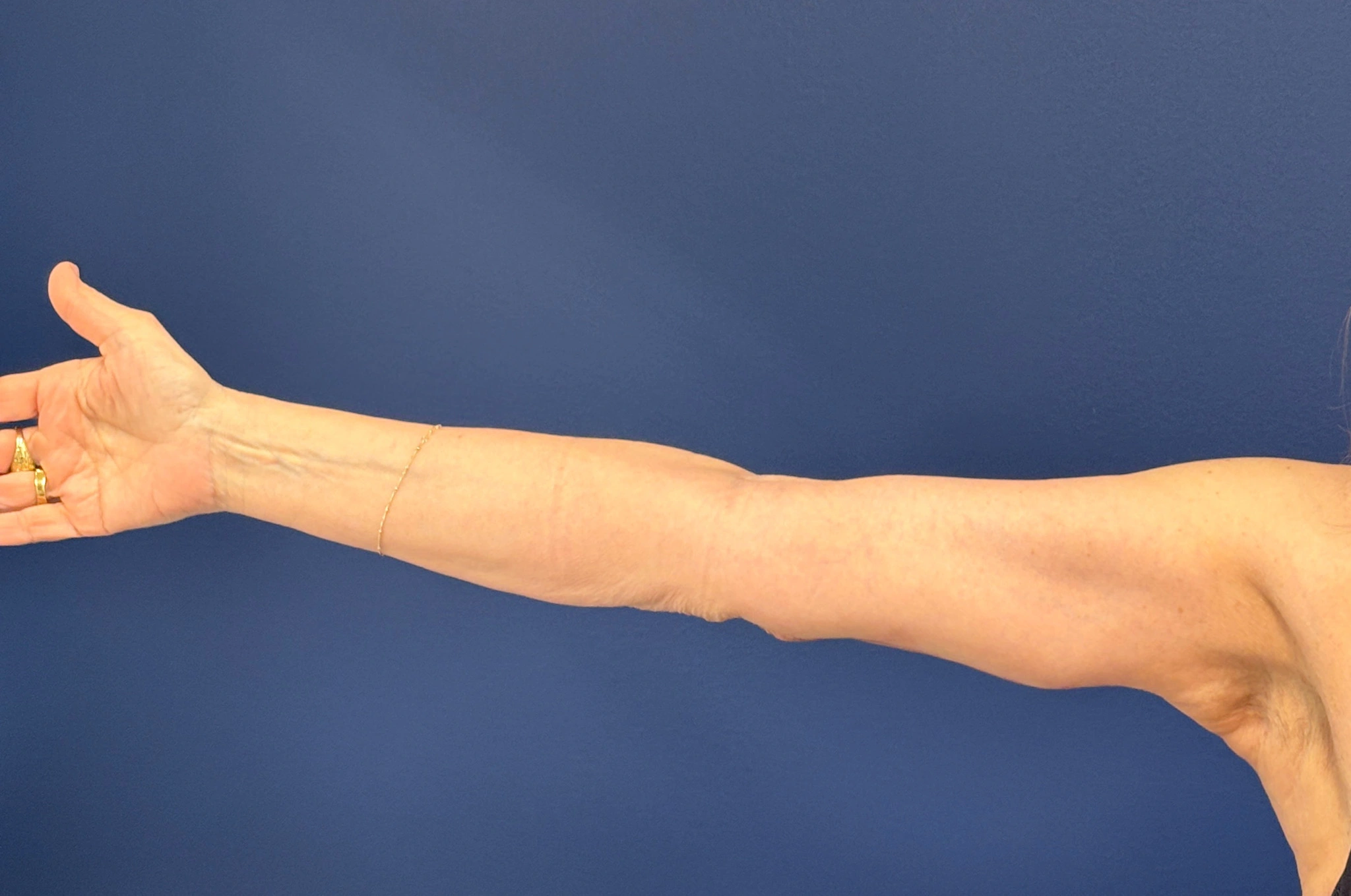 Brachioplasty-Case--3625 | After Arm Lift 6