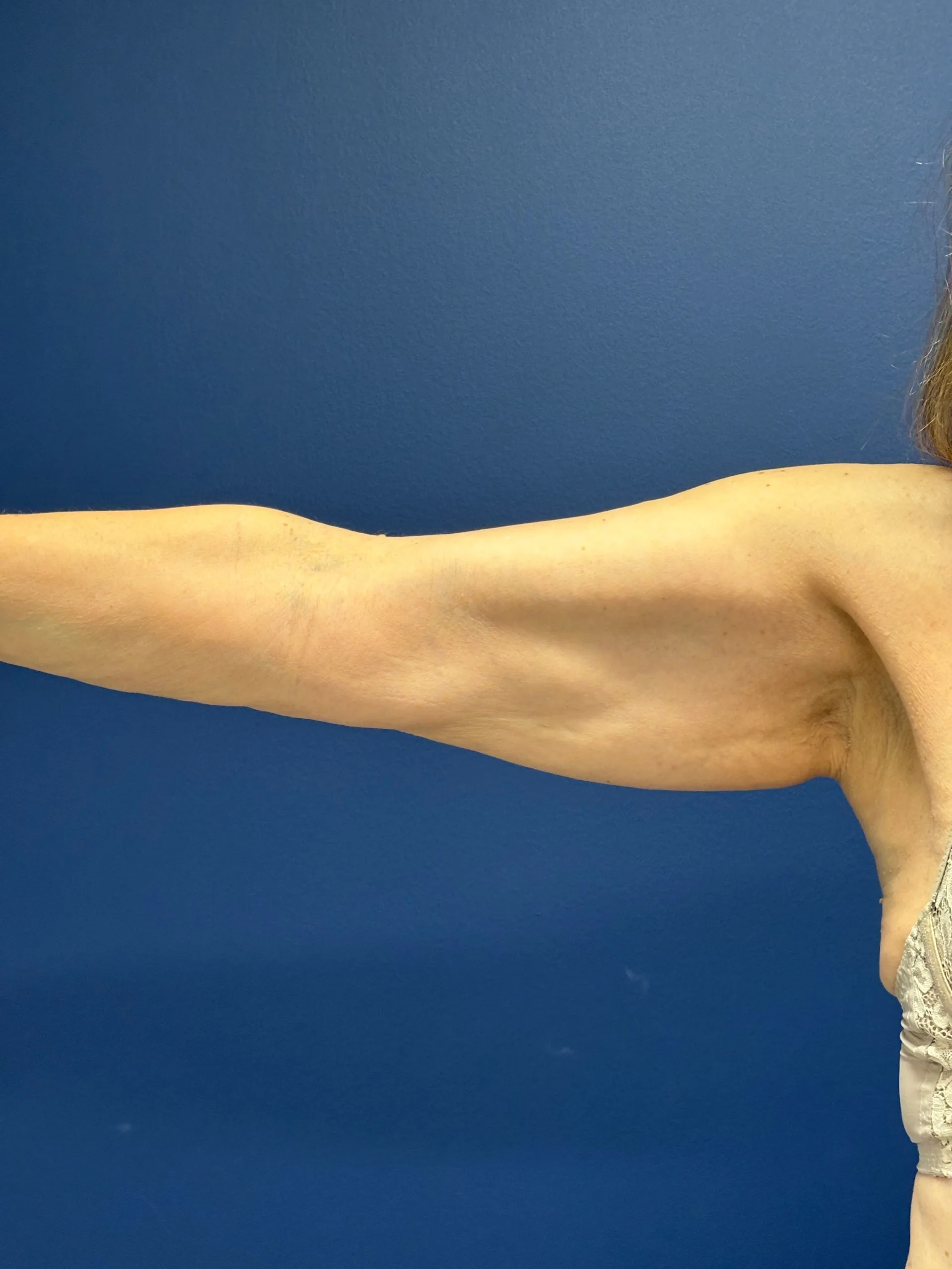 Brachioplasty-Case--3625 | Before Arm Lift 6