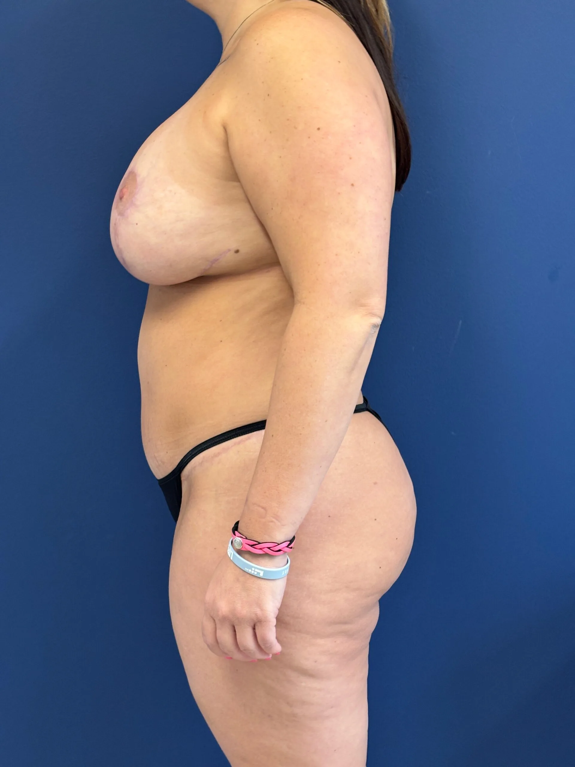 Abdominoplasty-Case--3117 | After Tummy Tuck 3