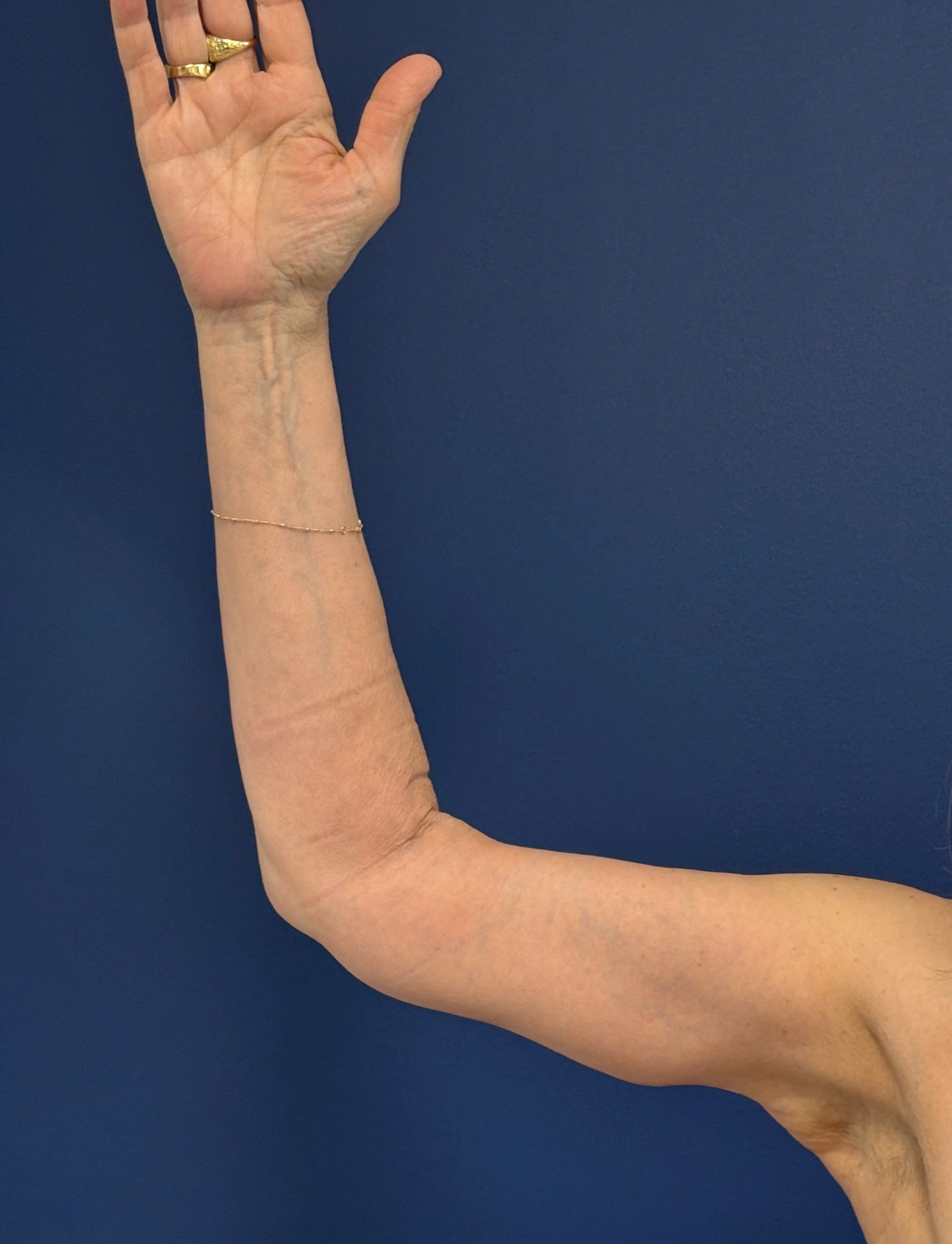 Brachioplasty-Case--3625 | After Arm Lift 2