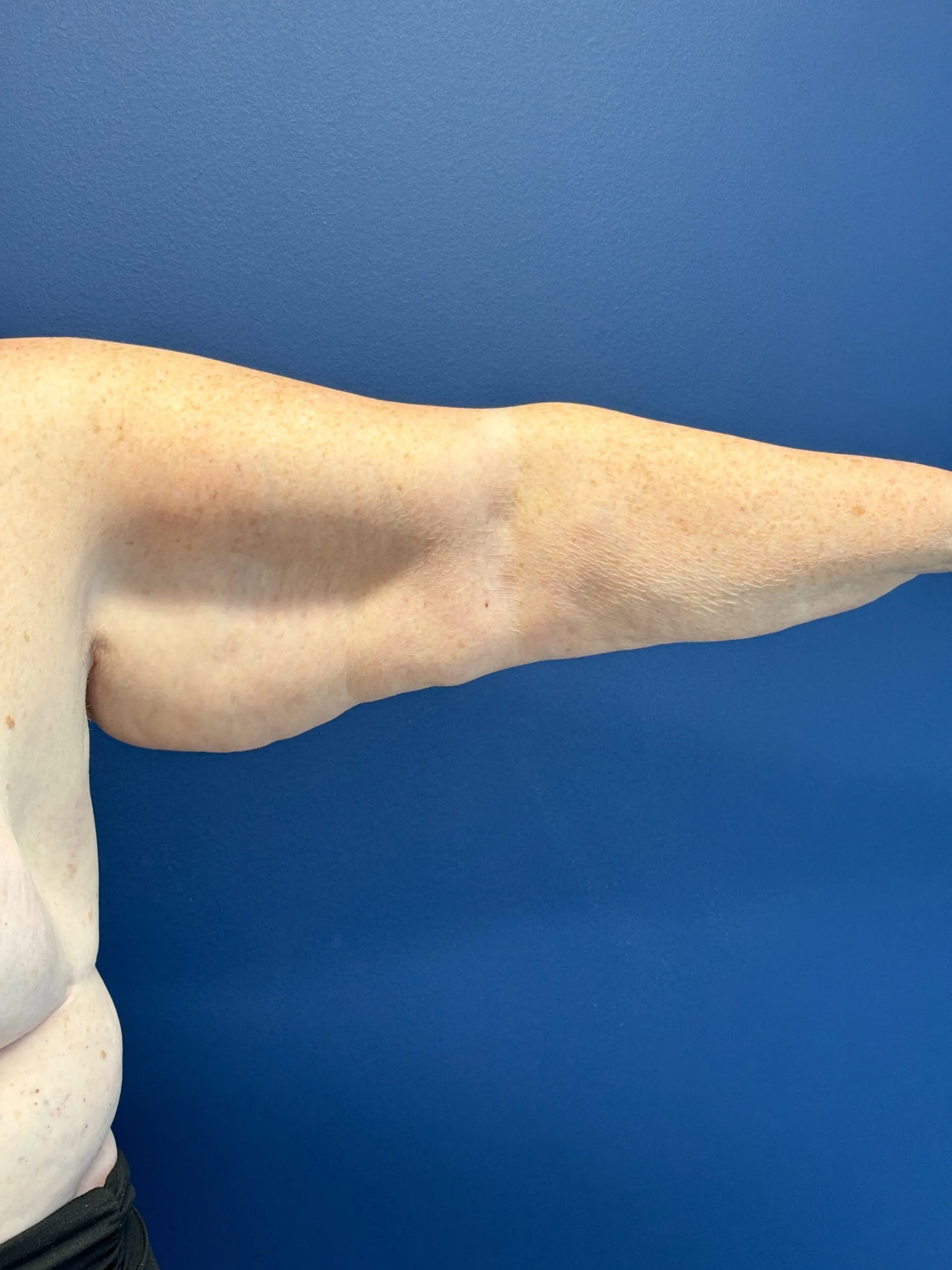 Brachioplasty-Case--5469 | Before Arm Lift 1