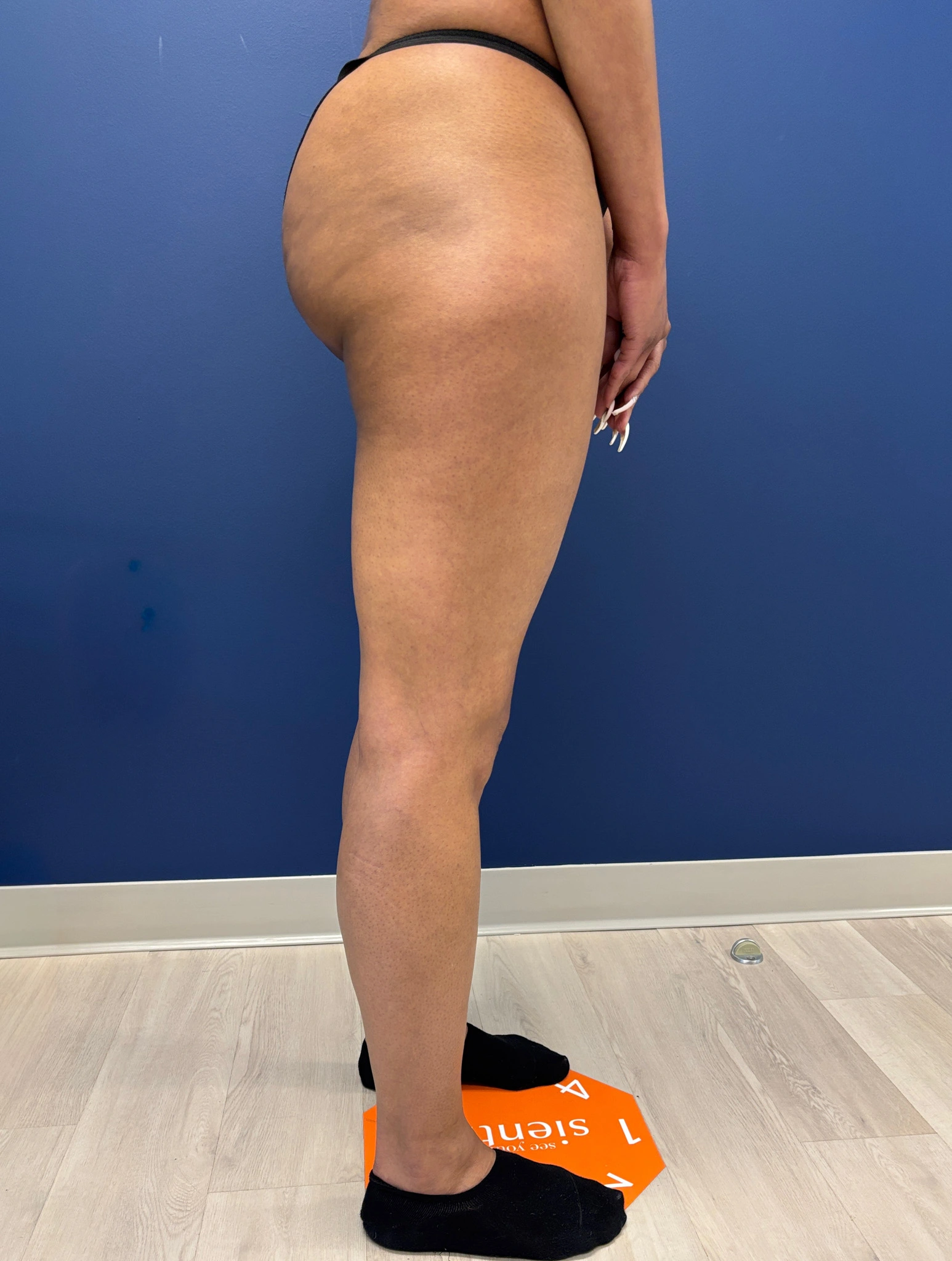 Lipo-360-Case--8130 | After Liposuction 8