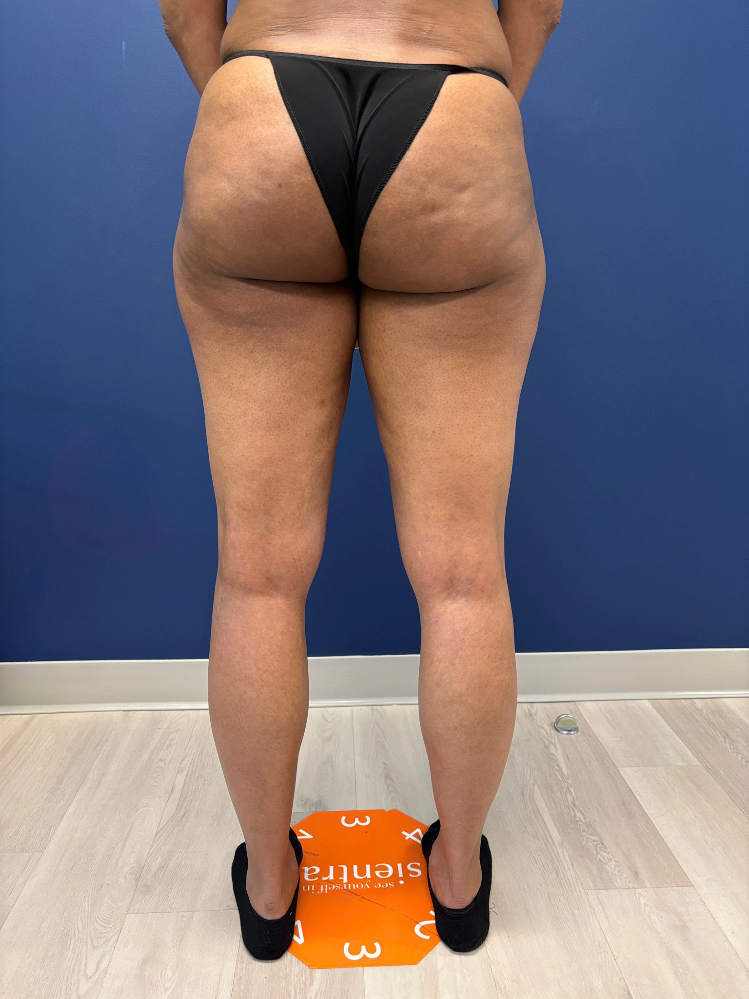 Lipo-360-Case--8130 | After Liposuction 6