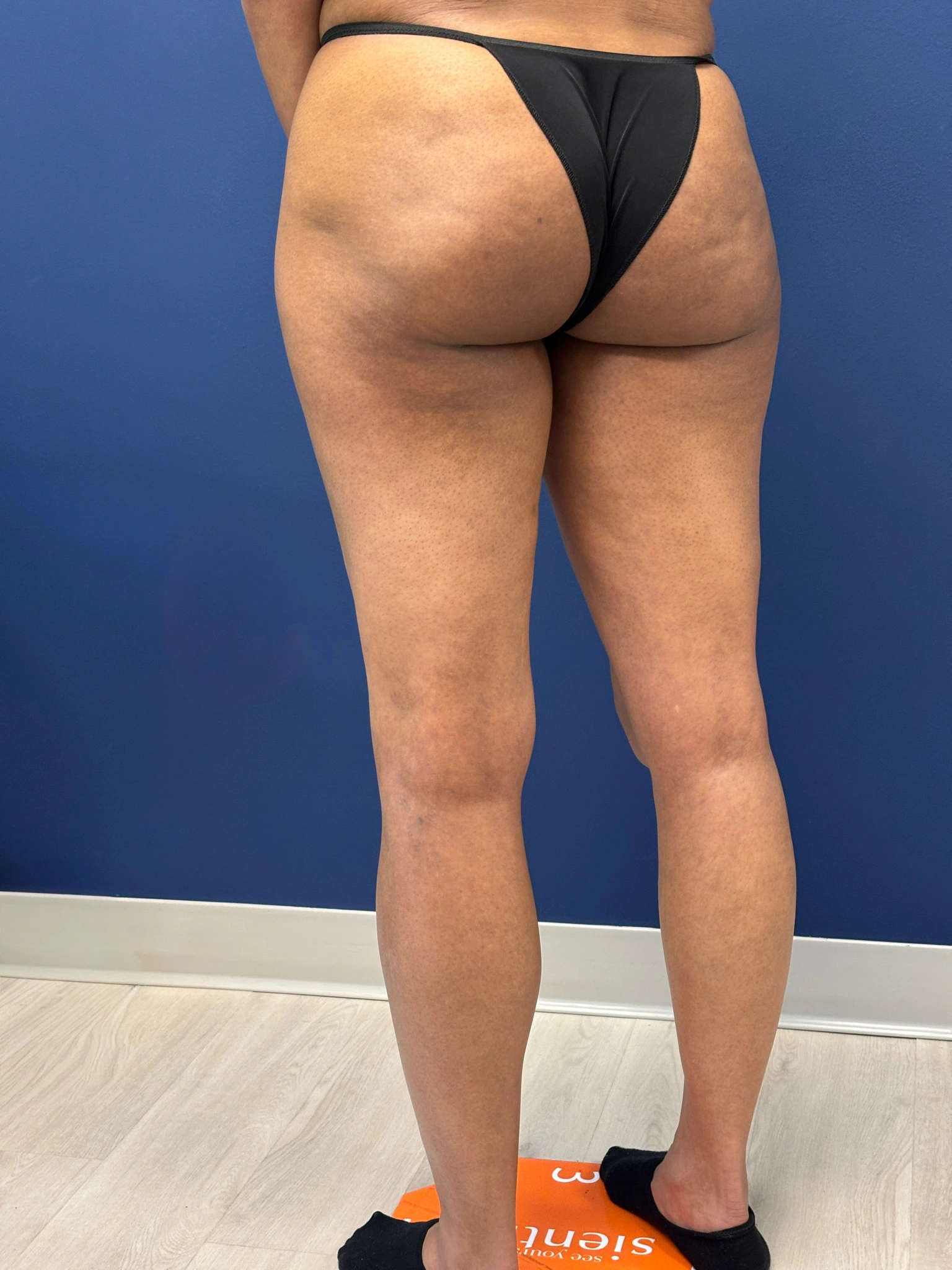 Lipo-360-Case--8130 | After Liposuction 9