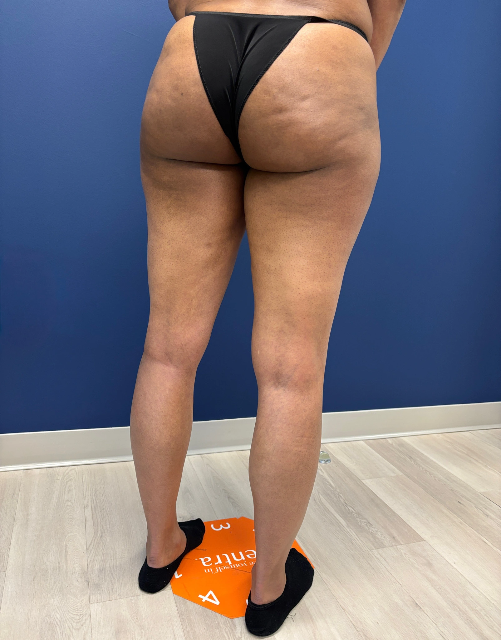 Lipo-360-Case--8130 | After Liposuction 10