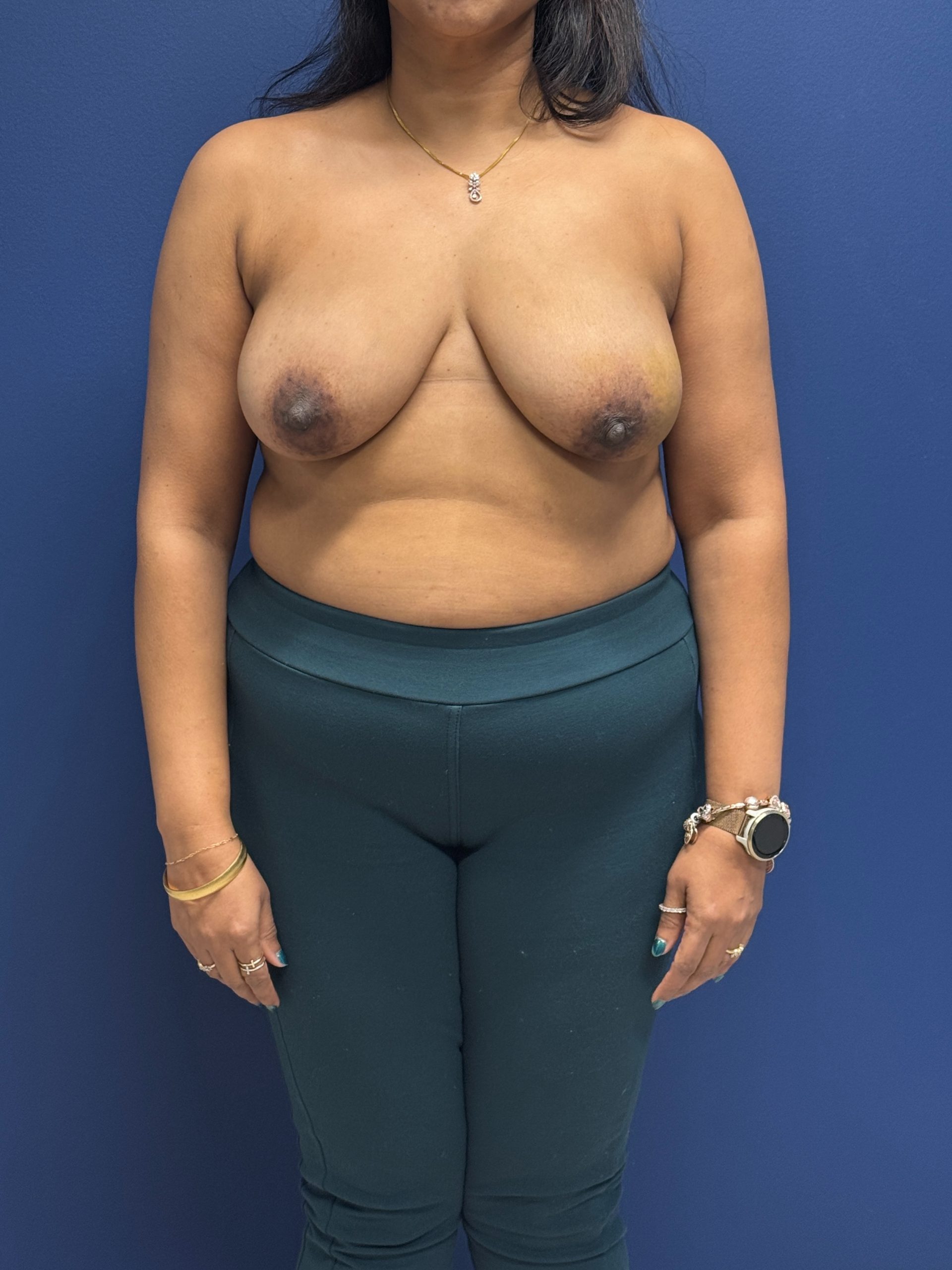 Left-Oncoplastic-Right-Reduction-Breast-Reconstruction-Case--9659 | Before Breast Reconstruction 1