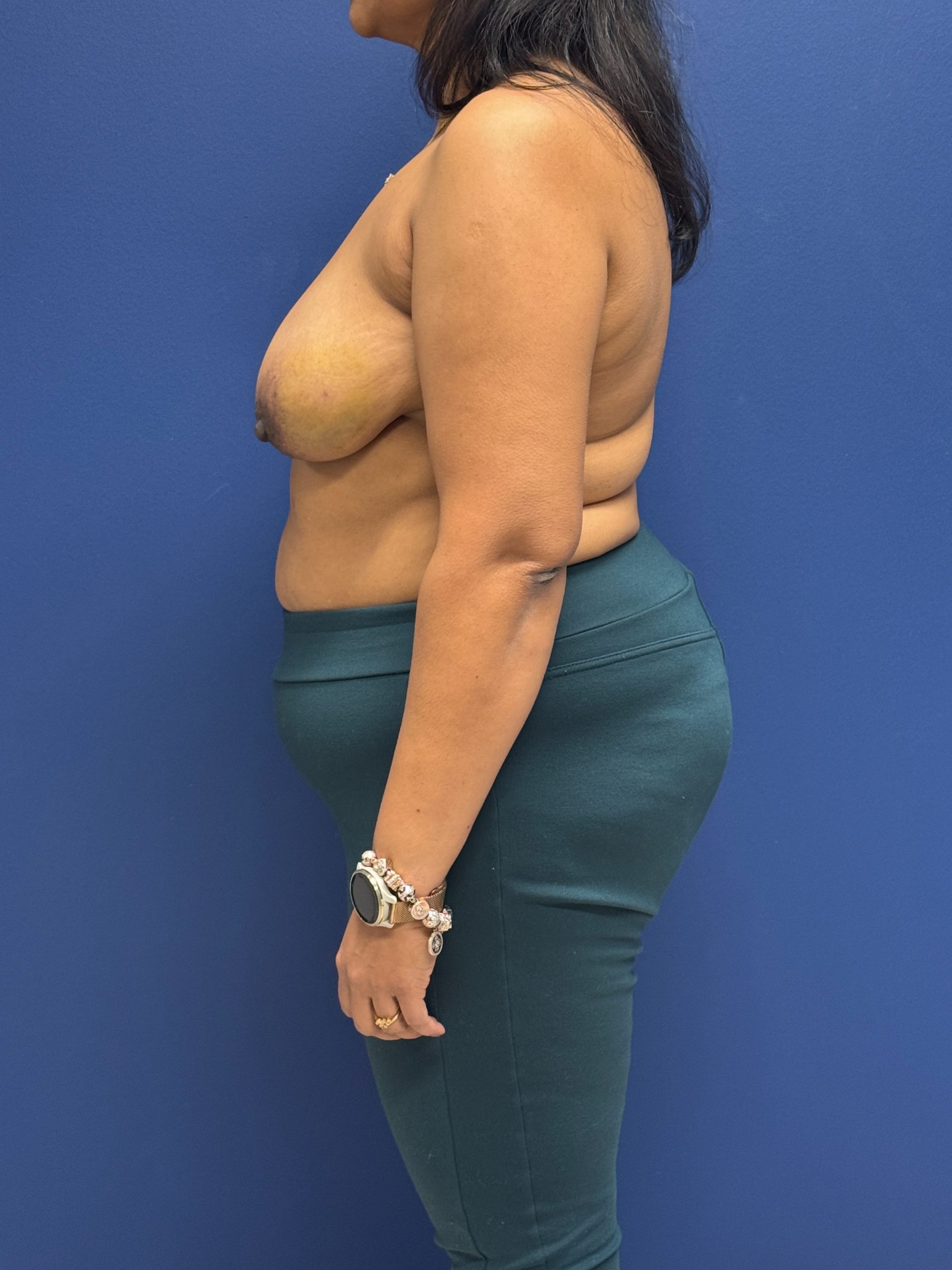 Left-Oncoplastic-Right-Reduction-Breast-Reconstruction-Case--9659 | Before Breast Reconstruction 2