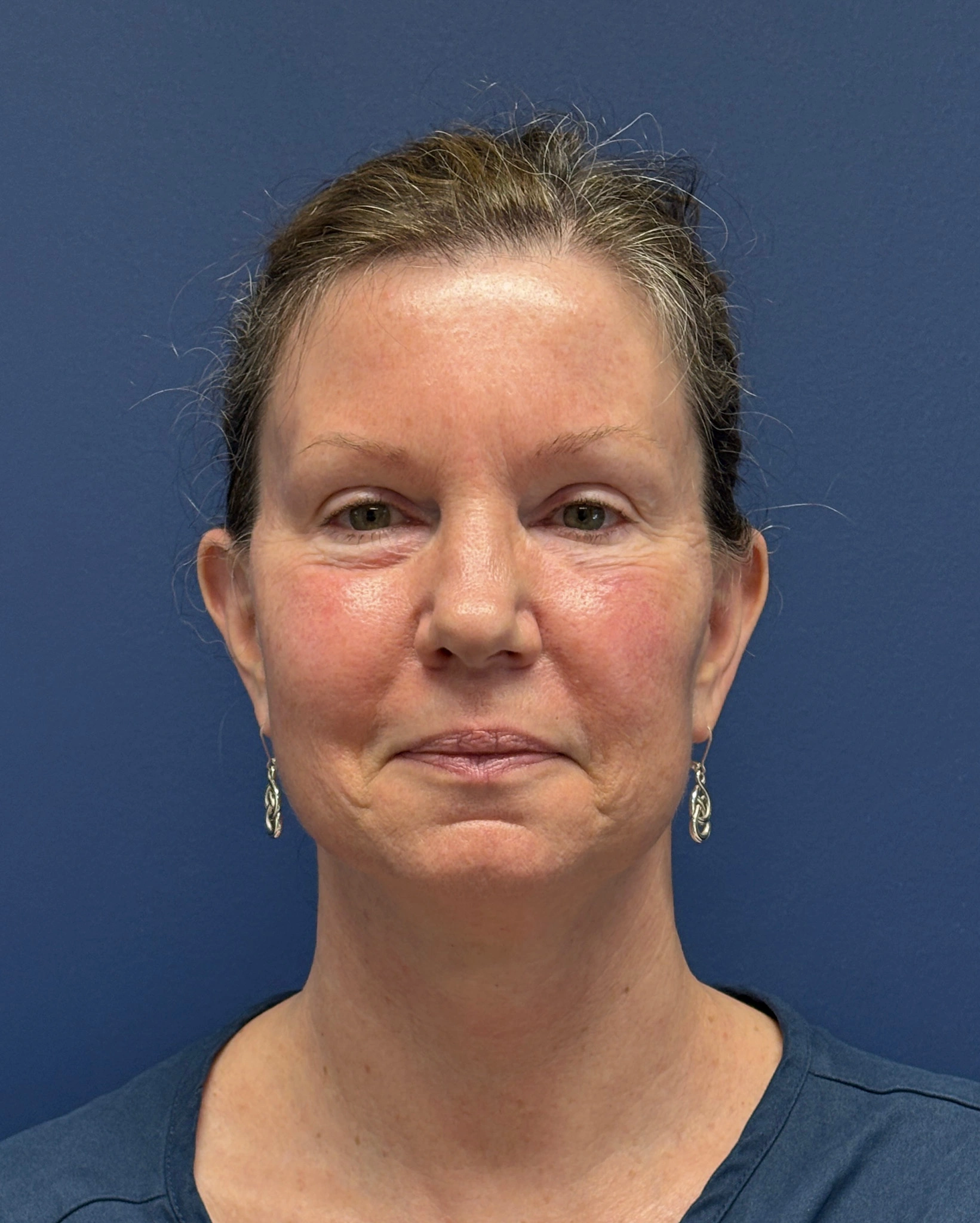 Facelift-Case--2304 | After Facelift 1