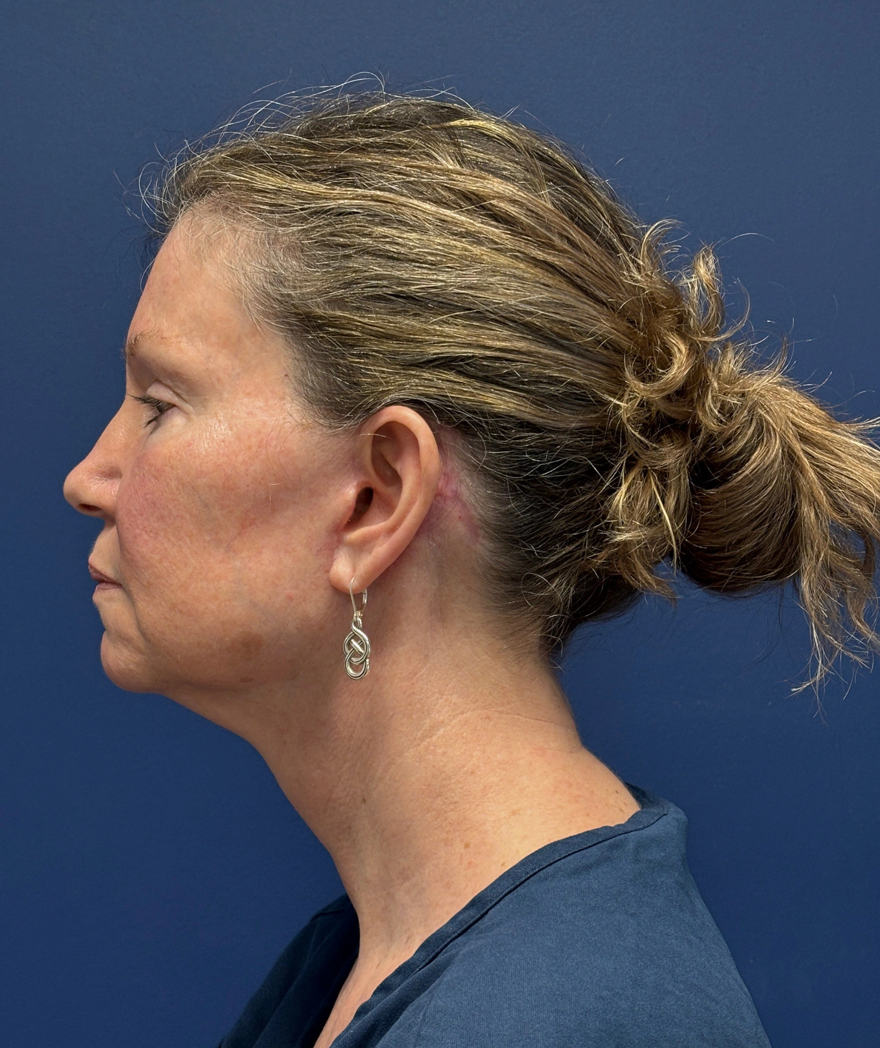 Facelift-Case--2304 | After Facelift 2