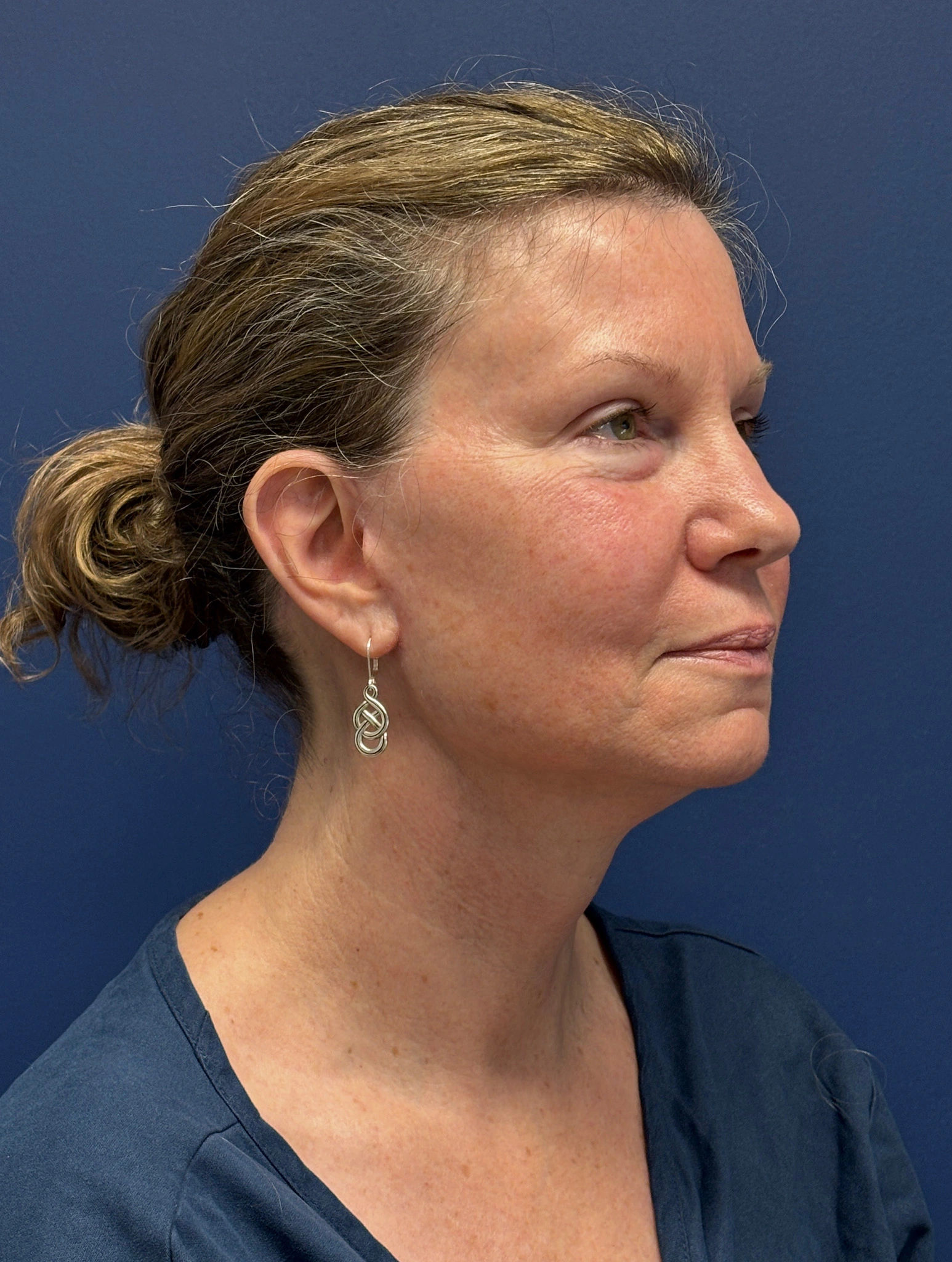 Facelift-Case--2304 | After Facelift 3