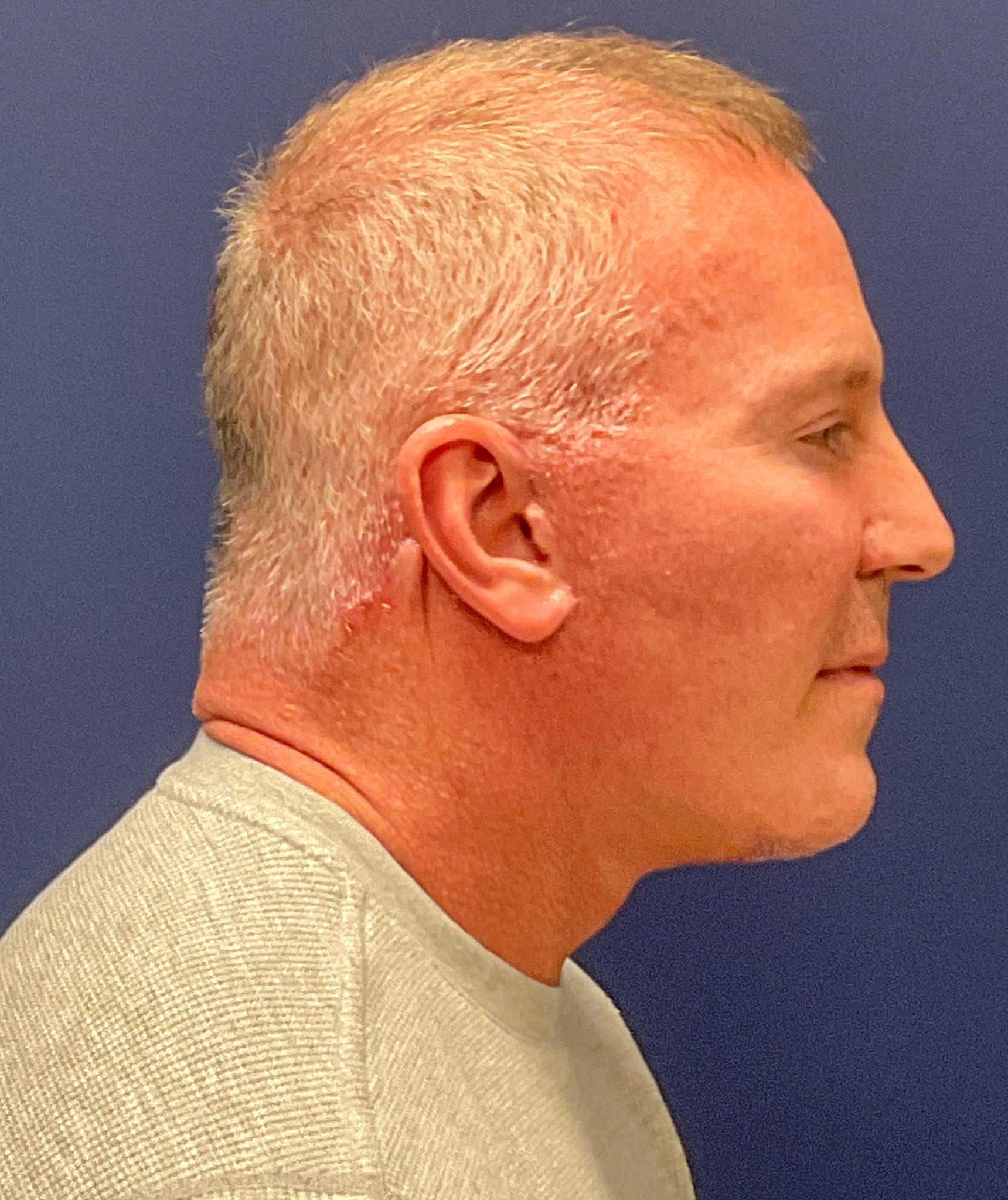 Facelift-Case--5246 | After Facelift 2