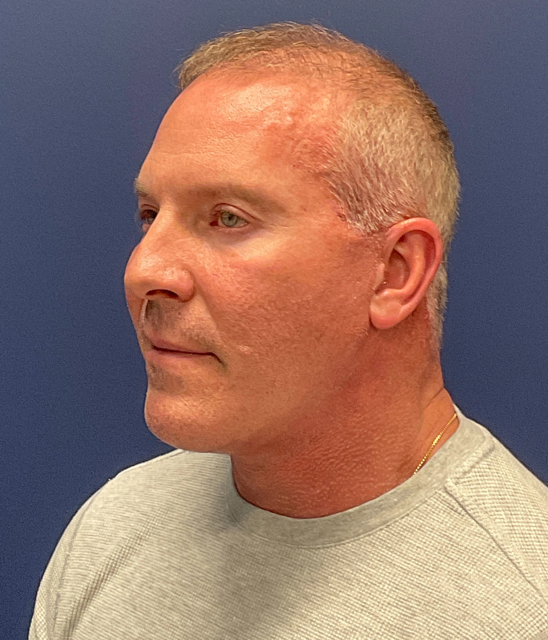 Facelift-Case--5246 | After Facelift 4