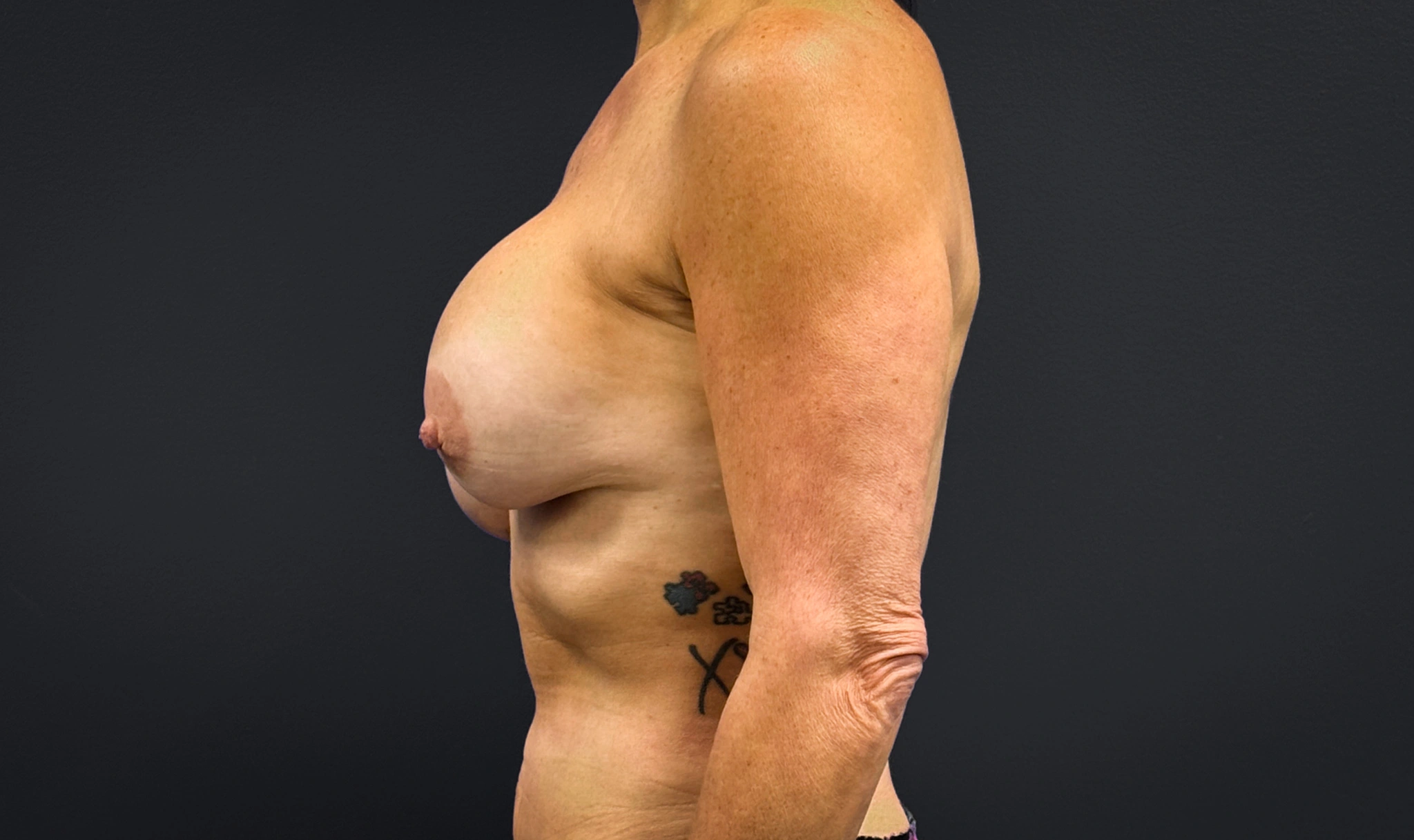 Left profile of patient before undergoing breast reconstruction surgery