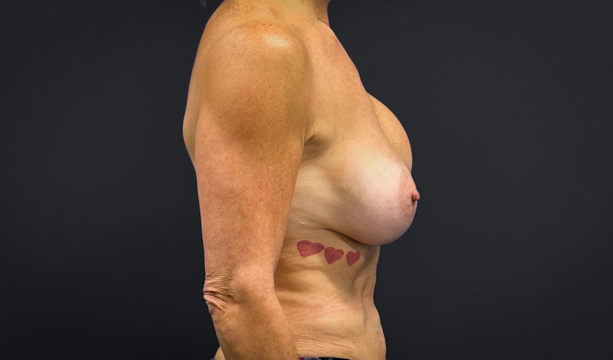 Right profile of patient before undergoing breast reconstruction surgery
