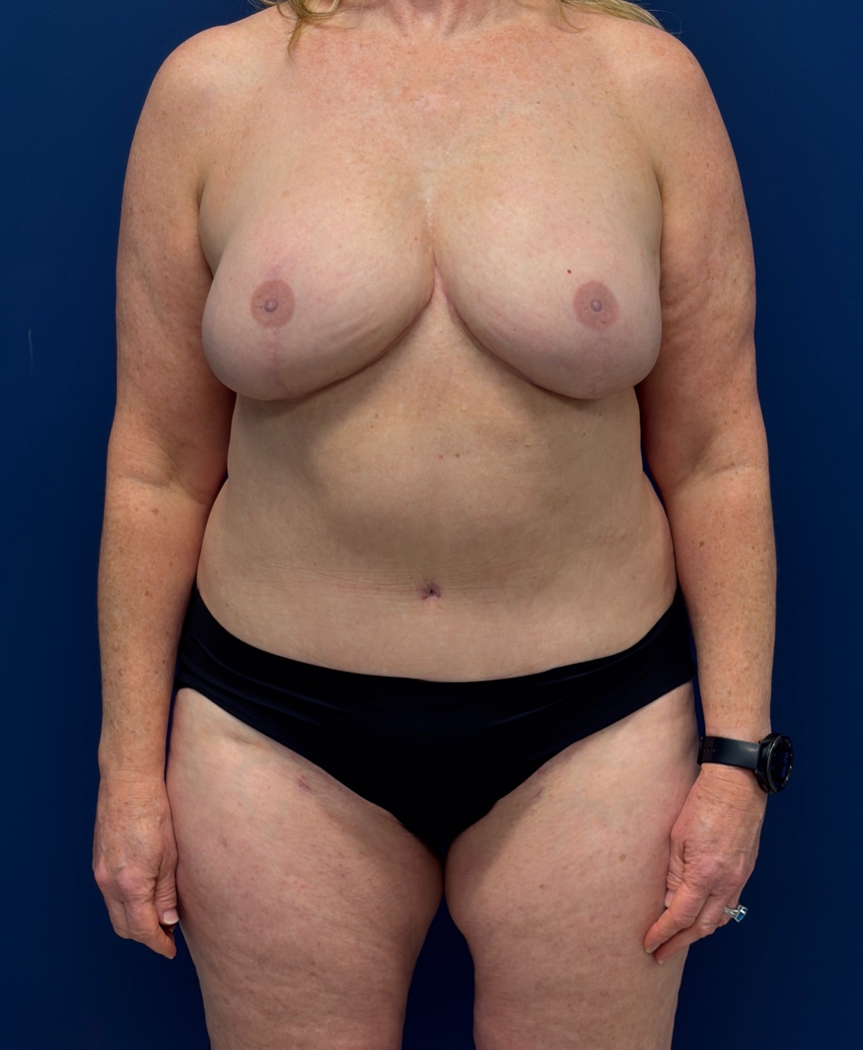 Bilateral-DIEP-Flap-Case--8499 | After DIEP Flap 1