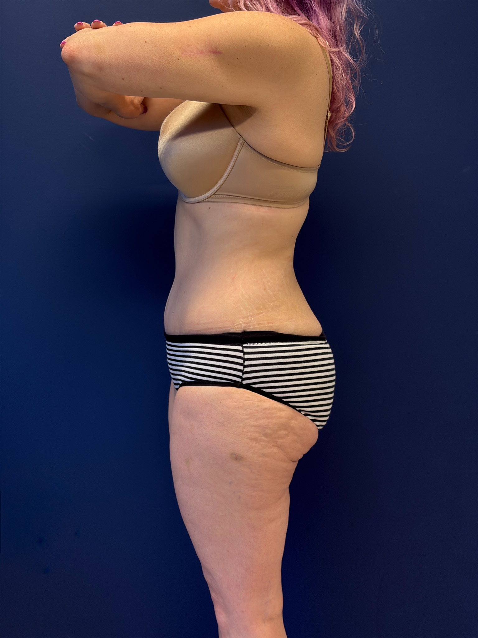 Abdominoplasty-Case--1856 | After Tummy Tuck 3