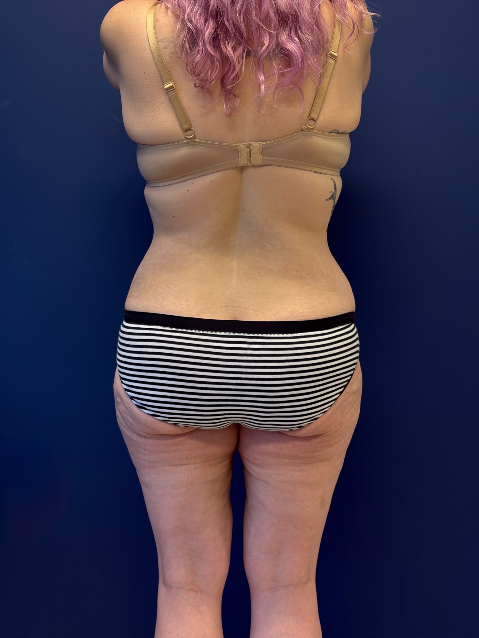 Abdominoplasty-Case--1856 | After Tummy Tuck 6