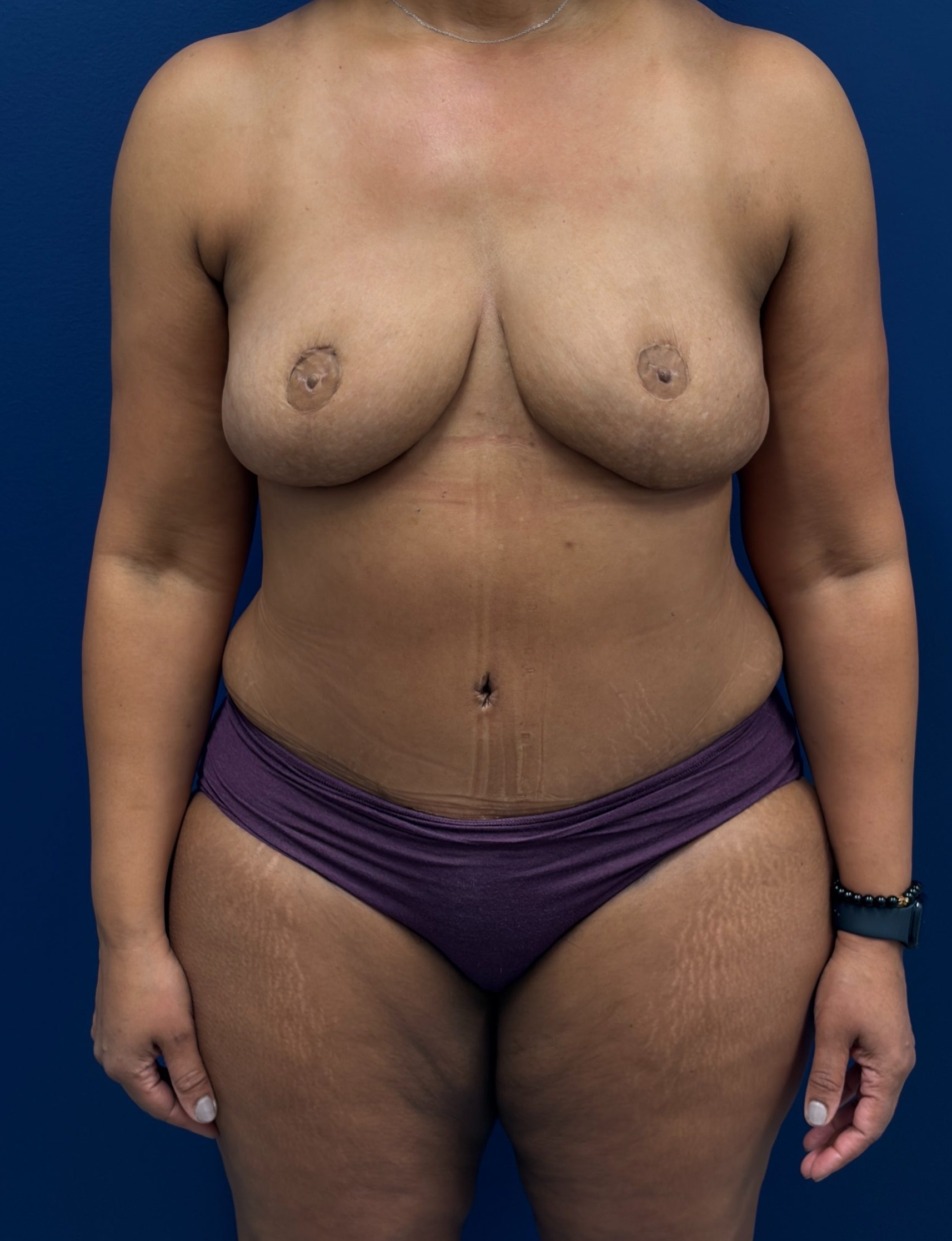 Bilateral-DIEP-Flap-Case--2073 | After DIEP Flap 1