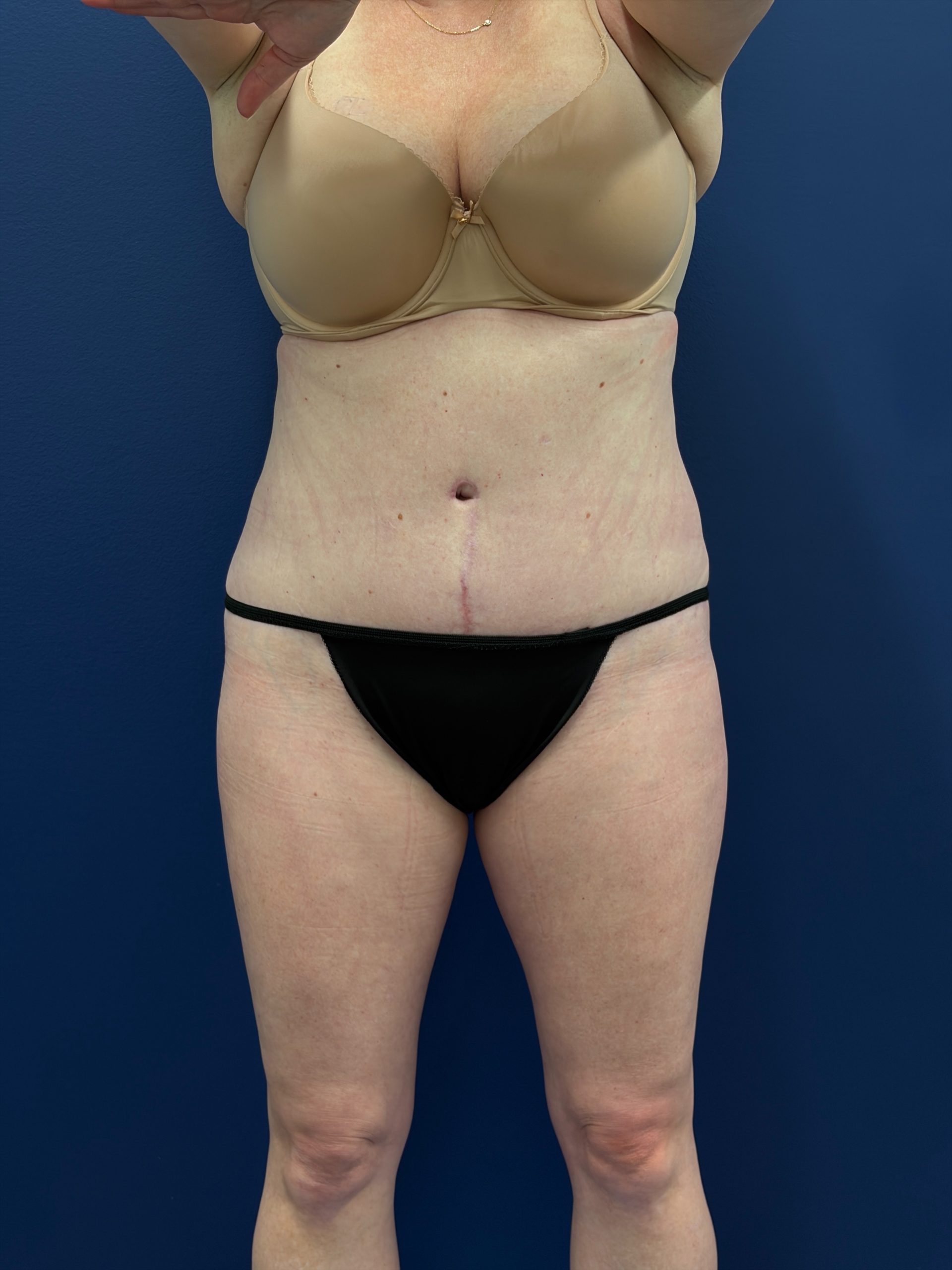 Abdominoplasty-Case--1715 | After Tummy Tuck 1