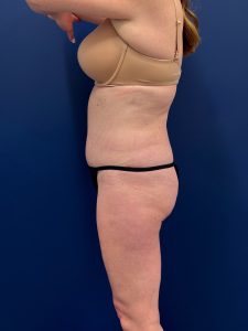 Abdominoplasty-Case--1715 | After Dr. Samir Rao 2