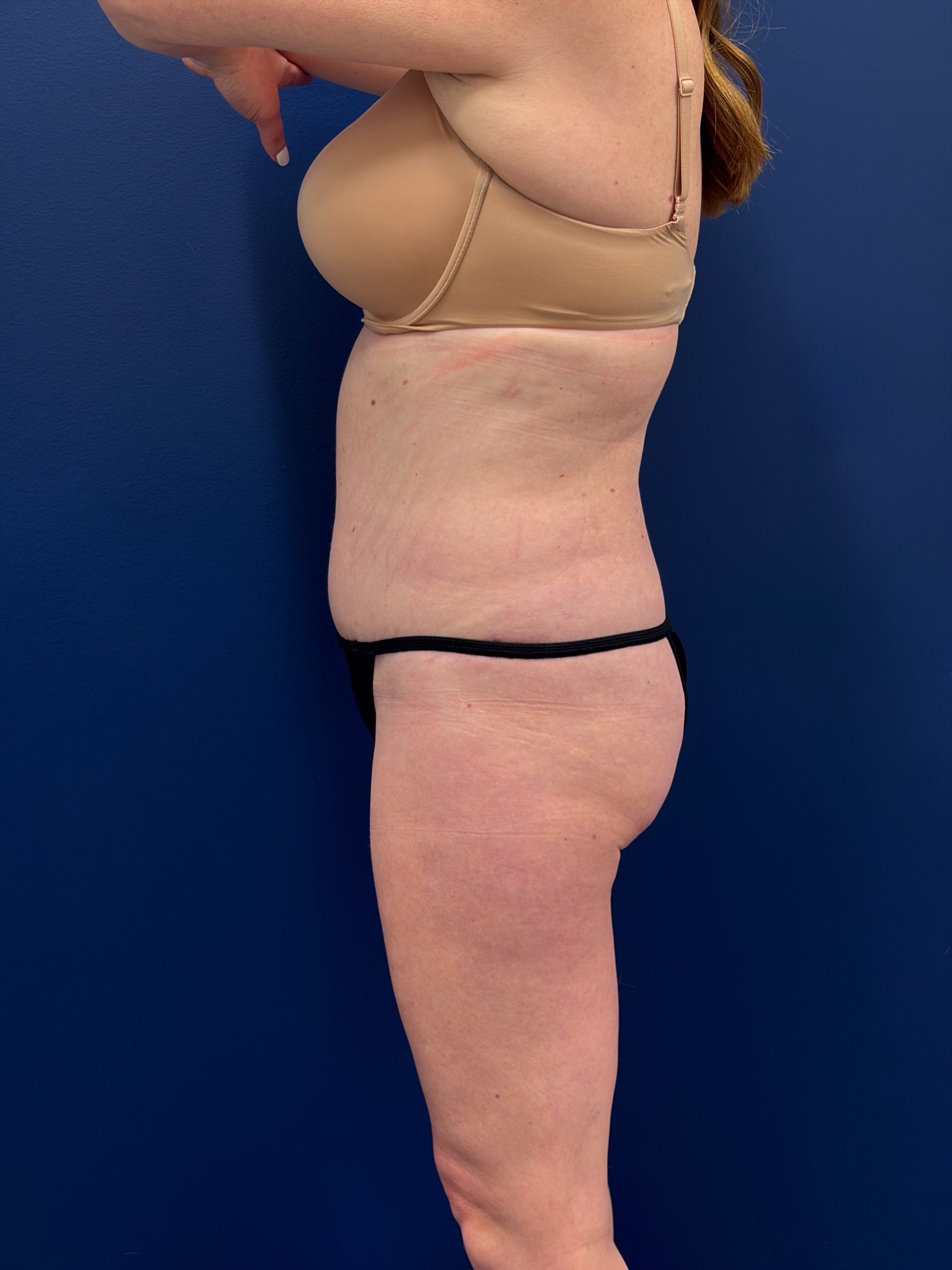 Abdominoplasty-Case--1715 | After Tummy Tuck 2