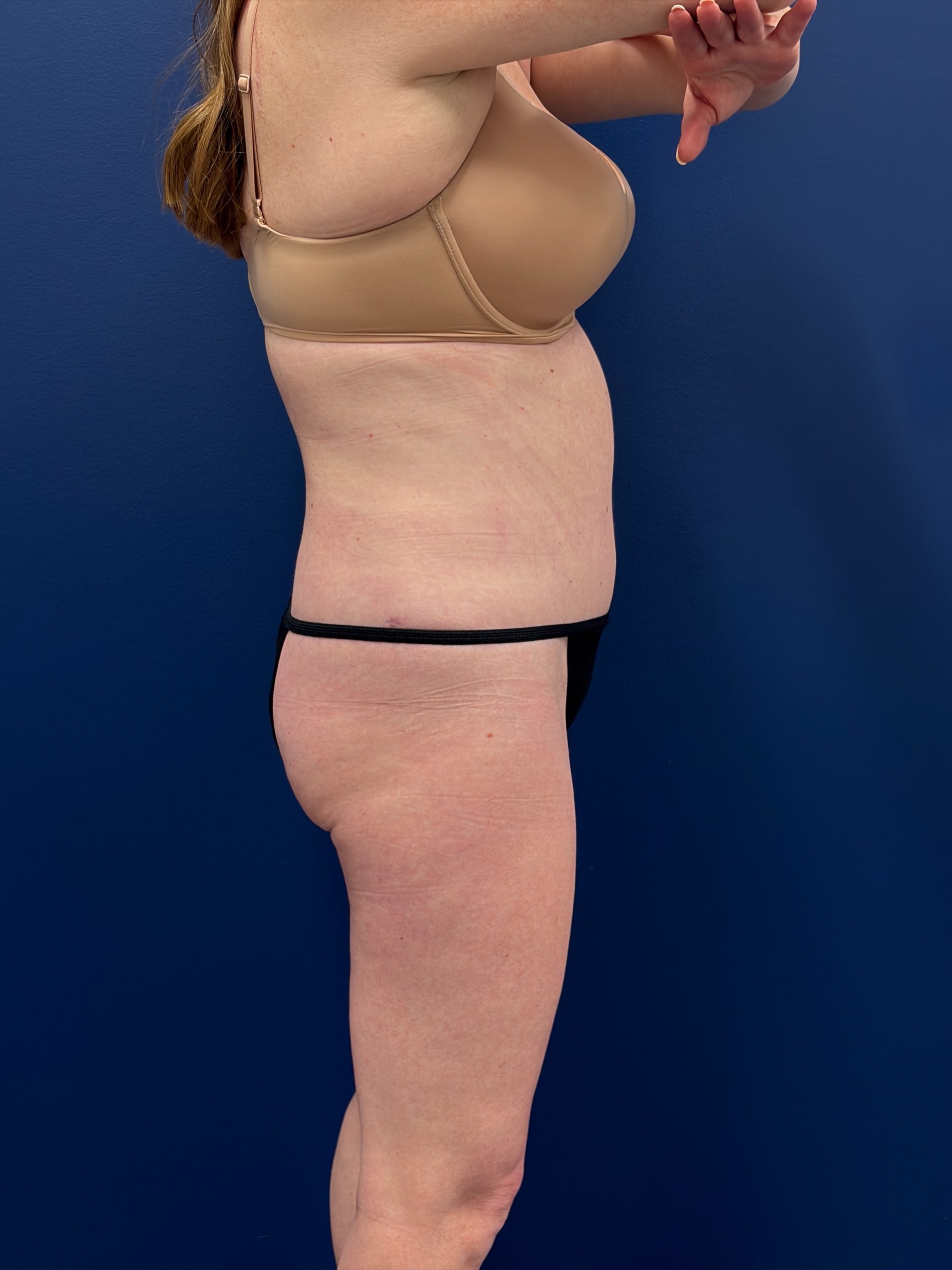 Abdominoplasty-Case--1715 | After Tummy Tuck 3