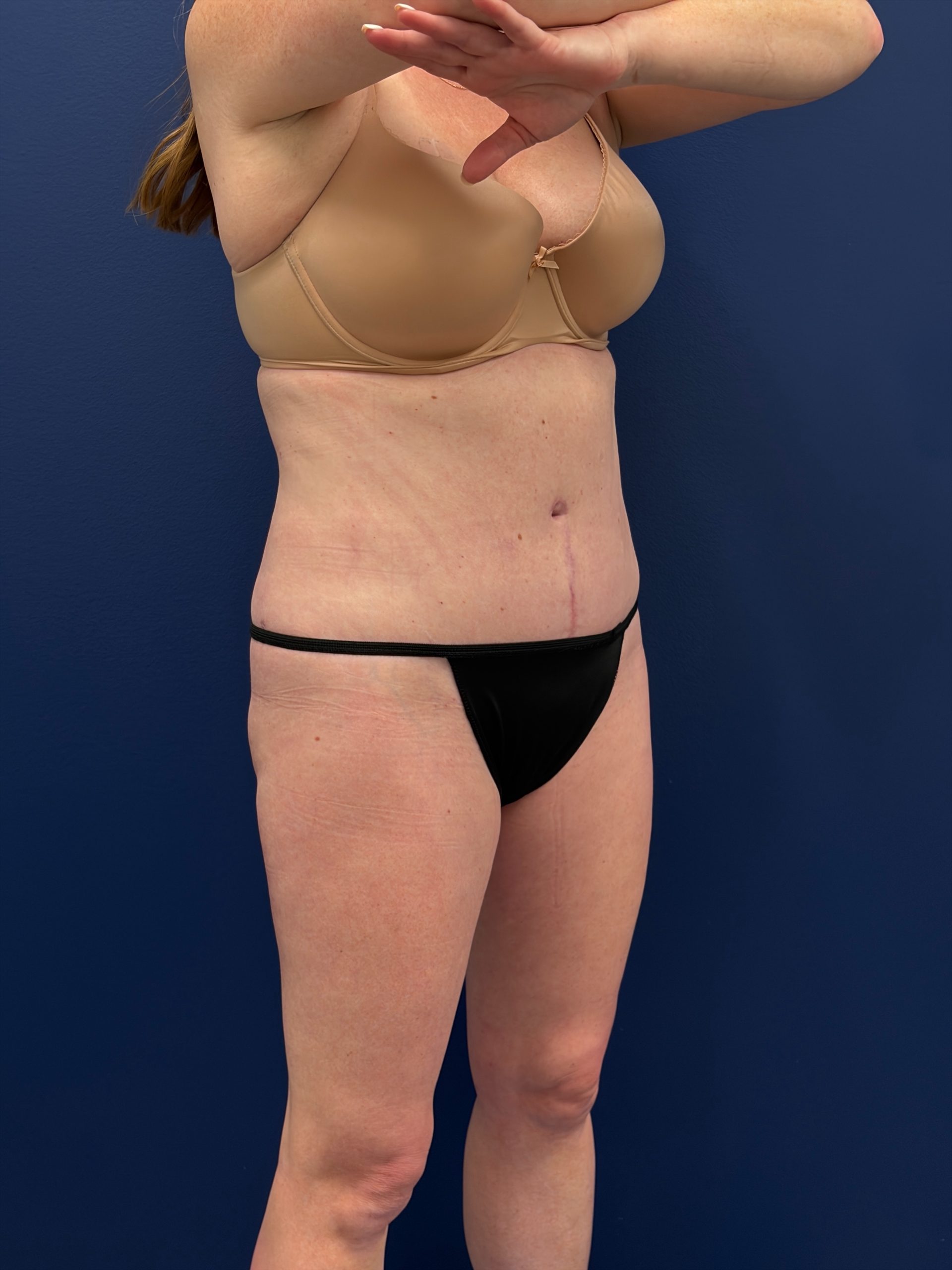 Abdominoplasty-Case--1715 | After Tummy Tuck 5