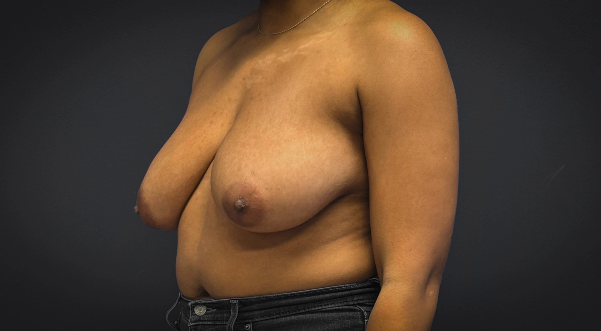 Breast-Reduction-Case--7089 | Before Breast Reduction 5