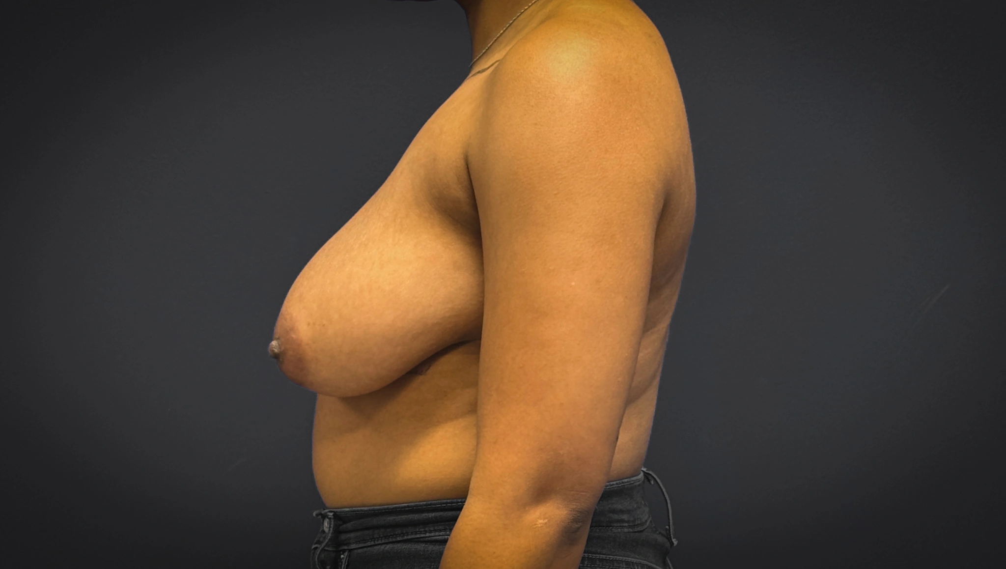 Breast-Reduction-Case--7089 | Before Breast Reduction 3