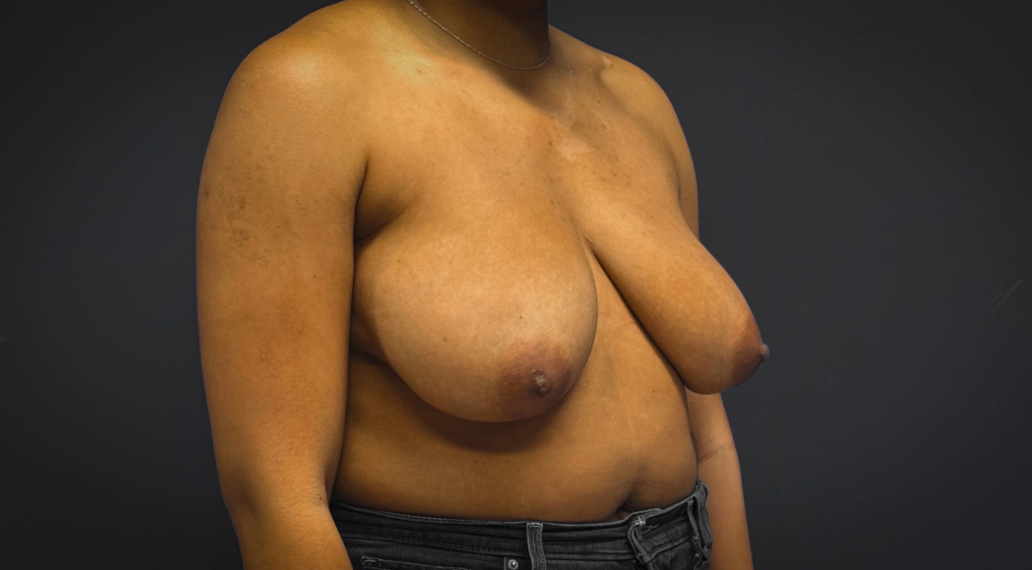 Breast-Reduction-Case--7089 | Before Breast Reduction 4