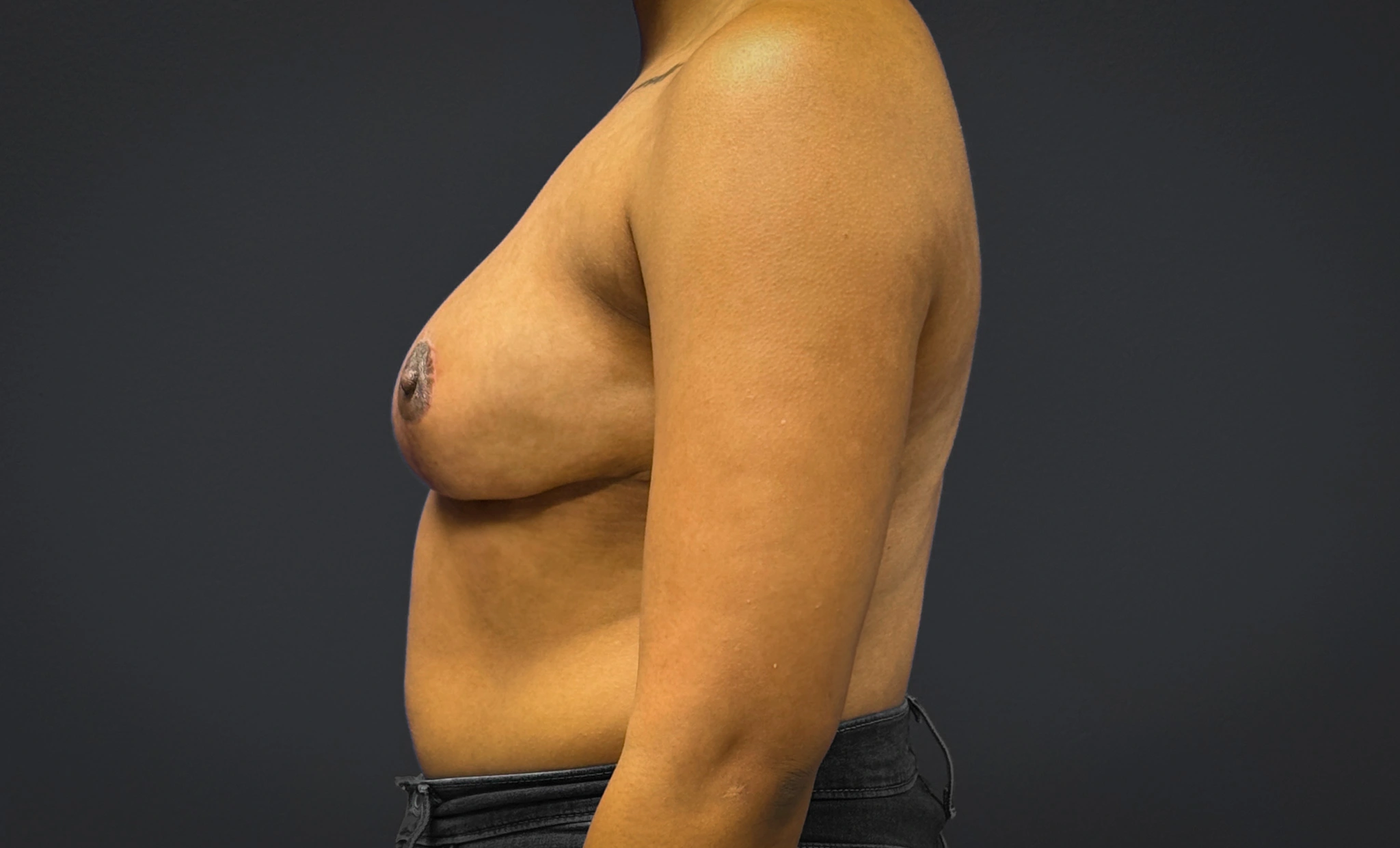 Breast-Reduction-Case--7089 | After Breast Reduction 3