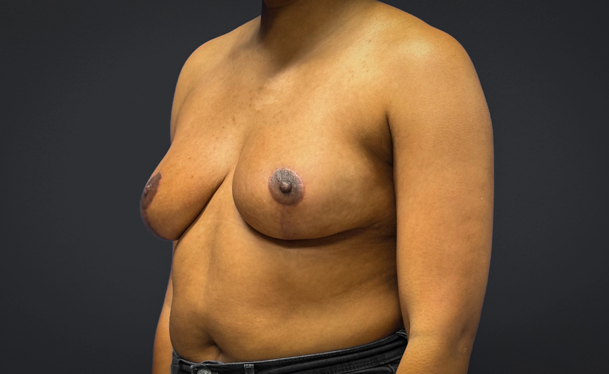 Breast-Reduction-Case--7089 | After Breast Reduction 5