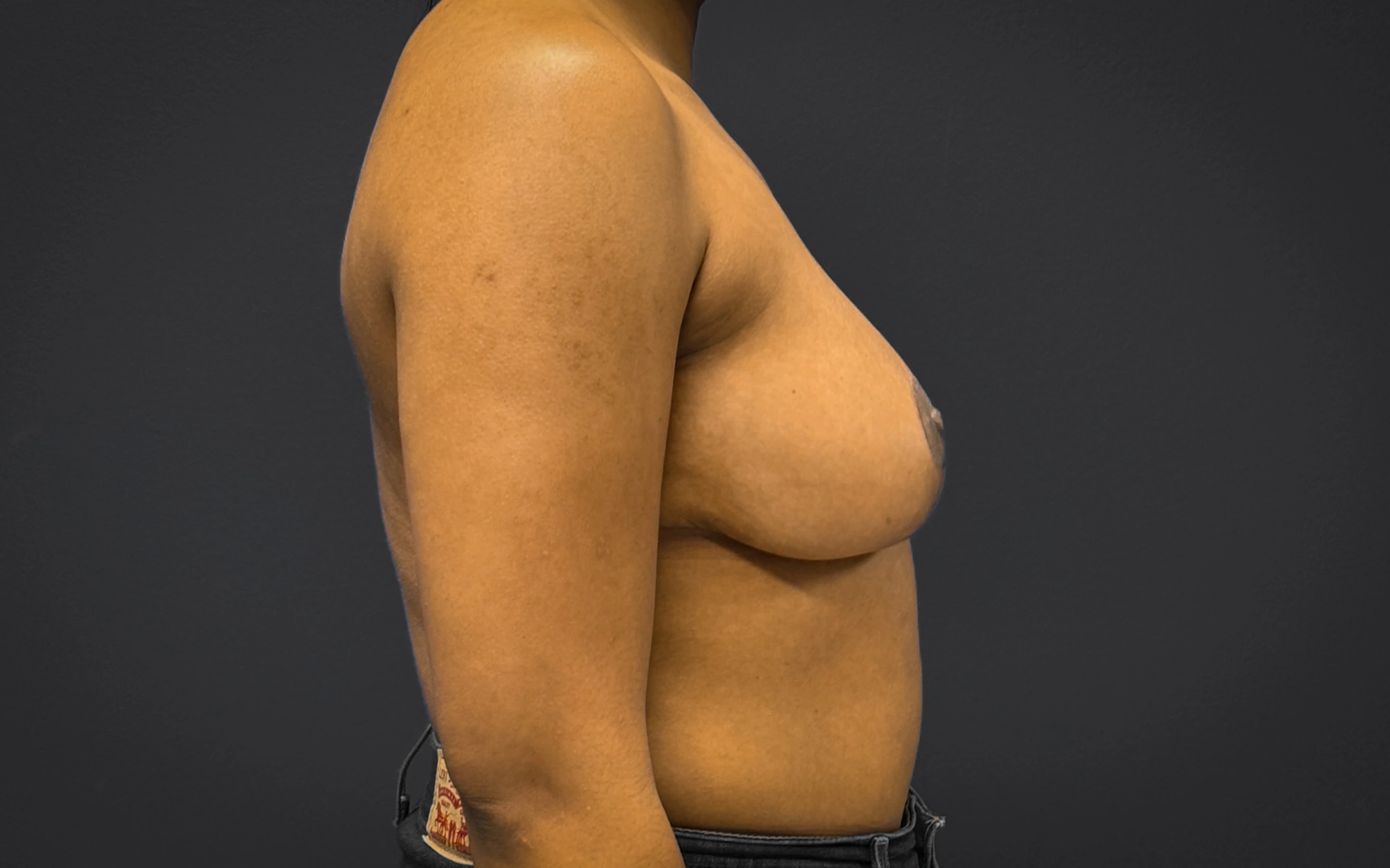 Breast-Reduction-Case--7089 | After Breast Reduction 2